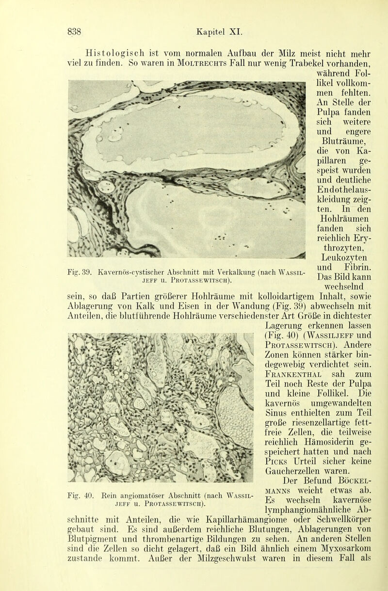 Fia;. 39. Kavernös-cystischer Abschnitt mit Verkalkung (nach Wassil- JEFF U. PrOTASSEWITSCH). Histologisch ist vom normalen Aufbau der Milz meist nicht mehr viel zu finden. So waren in Moltrechts Fall nur wenig Trabekel vorhanden, während Fol- likel vollkom- men fehlten. An Stelle der Pulpa fanden sich weitere und engere Bluträume, die von Ka- pillaren ge- speist wurden und deutliche Endothelaus- kleidung zeig- ten. In den Hohlräumen fanden sich reichlich Ery- throzyten, Leukozyten und Fibrin. Das Bild kann wechselnd sein, so daß Partien größerer Hohlräume mit kolloidartigem Inhalt, sowie Ablagerung von Kalk und Eisen in der Wandung (Fig. 39) abwechseln mit Anteilen, die blutführende Hohlräume verschiedenster Art Größe in dichtester Lagerung erkennen lassen (Fig. 40) (Wassiljeff und Protassewitsch). Andere Zonen können stärker bin- degewebig verdichtet sein. Frankenthal sah zum Teil noch Reste der Pulpa und kleine Follikel. Die kavernös umgewandelten Sinus enthielten zum Teil große riesenzellartige fett- freie Zellen, die teilweise reichlich Hämosiderin ge- speichert hatten und nach Picks Urteil sicher keine Gaucherzellen waren. Der Befund Böckel- manns weicht etwas ab. Es wechseln kavernöse lymphangiomähnliche Ab- schnitte mit Anteilen, die wie Kapillarhämangiome oder Schwellkörper gebaut sind. Es sind außerdem reichliche Blutungen, Ablagerungen von Blutpigment und thrombenartige Bildungen zu sehen. An anderen Stellen sind die Zellen so dicht gelagert, daß ein Bild ähnlich einem Myxosarkom zustande kommt. Außer der Milzgeschwulst waren in diesem Fall als Fig. 40. Rein angiomatöser Abschnitt (nach Wassil- jeff u. Protassewitsch).