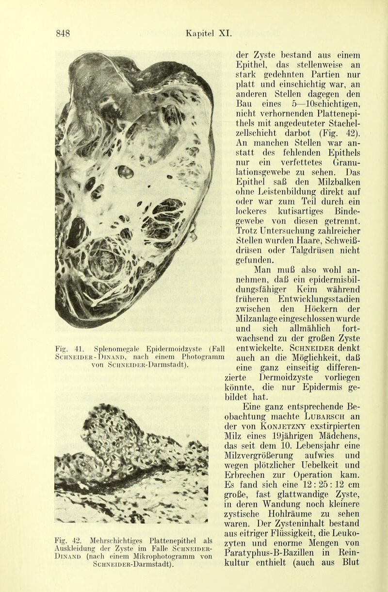 Fig. 41. Splenomegale Epidermoidzyste (Fall Schneider-Din and, nach einem Photogramm von S c hneid er-D armsta dt). Fig. 42. Mehrschichtiges Plattenepithel als Auskleidung der Zyste im Falle Schneider- Dinand (nach einem Mikrophotogramm von Schneid ER-Darmstadt). der Zyste bestand aus einem Epithel, das stellenweise an stark gedehnten Partien nur platt und einschichtig war, an anderen Stellen dagegen den Bau eines 5—lOschichtigen, nicht verhornenden Plattenepi- thels mit angedeuteter Stachel- zellschicht darbot (Fig. 42). An manchen Stellen war an- statt des fehlenden Epithels nur ein verfettetes Granu- lationsgewebe zu sehen. Das Epithel saß den Milzbalken ohne Leistenbildung direkt auf oder war zum Teil durch ein lockeres kutisartiges Binde- gewebe von diesen getrennt. Trotz Untersuchung zahlreicher Stellen wurden Haare, Schweiß- drüsen oder Talgdrüsen nicht gefunden. Man muß also wohl an- nehmen, daß ein epidermisbil- dungsfähiger Keim während früheren Entwicklungsstadien zwischen den Höckern der Milzanlage eingeschlossen wurde und sich allmählich fort- wachsend zu der großen Zyste entwickelte. Schneider denkt auch an die Möglichkeit, daß eine ganz einseitig differen- zierte Dermoidzyste vorliegen könnte, die nur Epidermis ge- bildet hat. Eine ganz entsprechende Be- obachtung machte Lubarsch an der von Konjetzny exstirpierten Milz eines 19jährigen Mädchens, das seit dem 10. Lebensjahr eine Milzvergrößerung aufwies und wegen plötzlicher Uebelkeit und Erbrechen zur Operation kam. Es fand sich eine 12 : 25 :12 cm große, fast glattwandige Zyste, in deren Wandung noch kleinere zystische Hohlräume zu sehen waren. Der Zysteninhalt bestand aus eitriger Flüssigkeit, die Leuko- zyten und enorme Mengen von Paratyphus-B-Bazillen in Rein- kultur enthielt (auch aus Blut