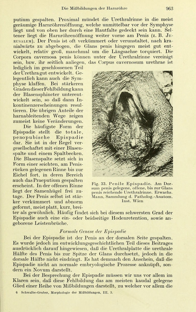 putium gespalten. Proximal mündet die Urethralrinne in die meist geräumige Harnröhrenöffnung, welche unmittelbar vor der Symphyse liegt und von oben her durch eine Hautfalte gedeckt sein kann. Sel- tener liegt die Harnröhrenöffnung weiter vorne am Penis (z. B. Je- rusalem). Der Penis ist oft verkümmert oder verunstaltet, nach kra- nialwärts zu abgebogen, die Glans penis hingegen meist gut ent- wickelt, relativ groß, manchmal um die Längsachse torquiert. Die Corpora cavernosa penis können unter der Urethralrinne vereinigt sein, bzw. ihr seitlich anliegen, das Corpus cavernosum urethrae ist lediglich im geschlossenen Teil der Urethra gut entwickelt. Ge- legentlich kann auch die Sym- physe klaffen. Bei stärkeren Graden dieserFehlbildung kann der Blasensphincter unterent- wickelt sein, so daß dann In- kontinenzerscheinungen resul- tieren. Die übrigen Anteile der harnableitenden Wege zeigen zumeist keine Veränderungen. Die häufigste Form der Epispadie stellt die totale, penopubische Epispadie dar. Sie ist in der Regel ver- gesellschaftet mit einer Blasen- spalte und einem Spaltbecken. Die Blasenspalte setzt sich in Form einer seichten, am Penis- rücken gelegenen Rinne bis zur Eichel fort, in deren Bereich auch dasPraeputium gespalten erscheint. In der offenen Rinne liegt der Samenhügel frei zu- tage. Der Penis selbst ist stär- ker verkümmert und abnorm geformt, meistplatt, kurz, brei- ter als gewöhnlich. Häufig findet sich bei diesem schwersten Grad der Epispadie auch eine ein- oder beidseitige Hodenretention, sowie an- geborene Leistenbrüche. Formale Genese der Epispadie Bei der Epispadie ist der Penis an der dorsalen Seite gespalten. Es wurde jedoch im entwicklungsgeschichtlichen Teil dieses Beitrages ausdrücklich darauf hingewiesen, daß die Urethralplatte die urethrale Hälfte des Penis bis zur Spitze der Glans durchsetzt, jedoch in die dorsale Hälfte nicht eindringt. Es hat demnach den Anschein, daß die Epispadie nicht an normale embryologische Prozesse anknüpft, son- dern ein Novum darstellt. Bei der Besprechung der Epispadie müssen wir uns vor allem im Klaren sein, daß diese Fehlbildung das am meisten kaudal gelegene Glied einer Reihe von Mißbildungen darstellt, zu welcher vor allem die 6 Schwalbe-Gruber, Morphologie der Mißbildungen, III, 3. Fig. 33. Penile Epispadie. Am Dor- sum penis gelegene, offene, bis zur Glans penis reichende Urethralrinne. Erwachs. Mann, Sammlung d. Patholog.-Anatom, Inst. Wien