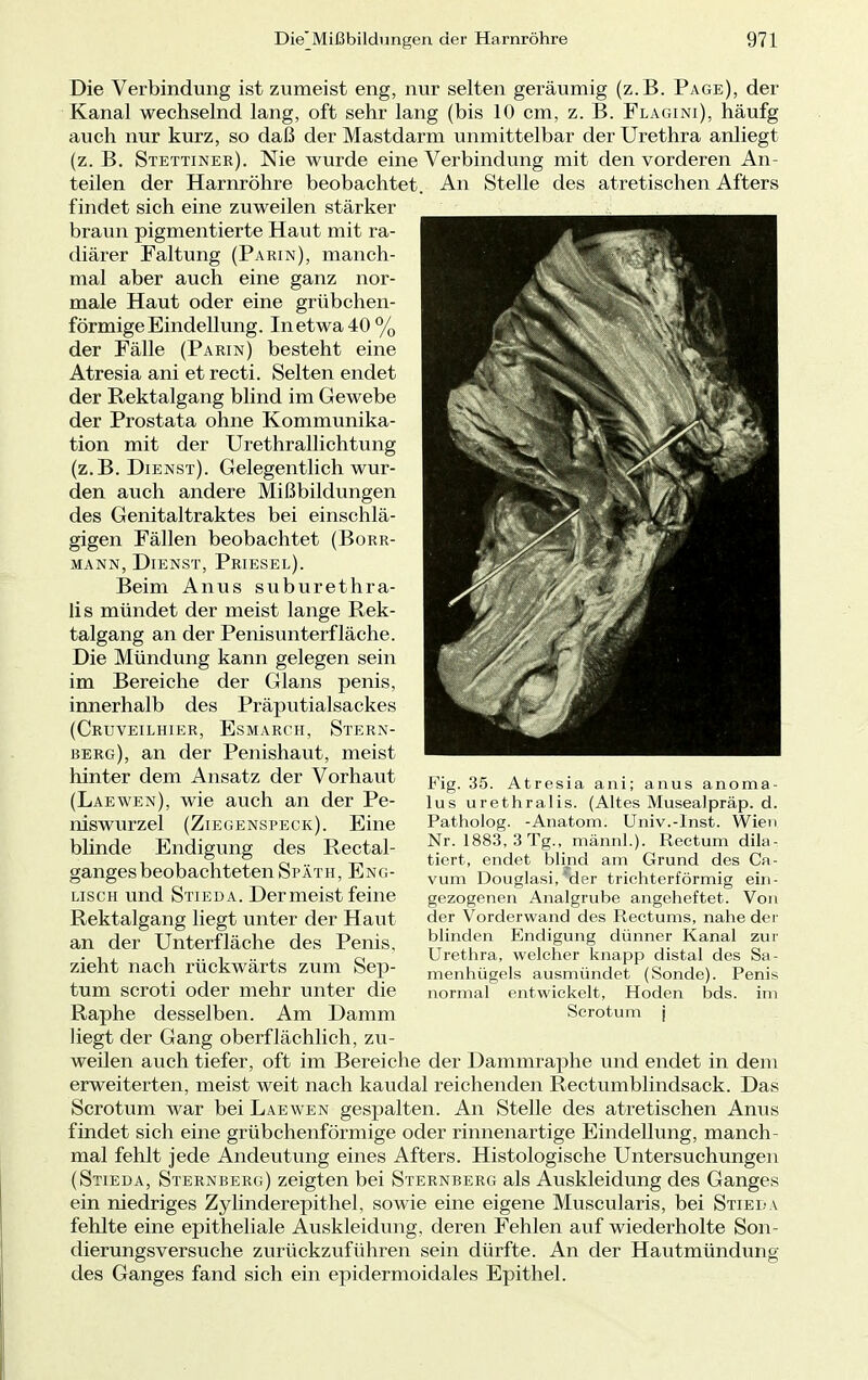 Die Verbindung ist zumeist eng, nur selten geräumig (z.B. Page), der Kanal wechselnd lang, oft sehr lang (bis 10 cm, z. B. Flagini), häufg auch nur kurz, so daß der Mastdarm unmittelbar der Urethra anliegt (z. B. Stettiner). Nie wurde eine Verbindung mit den vorderen An- teilen der Harnröhre beobachtet. An Stelle des atretischen Afters findet sich eine zuweilen stärker braun pigmentierte Haut mit ra- diärer Faltung (Parin), manch- mal aber auch eine ganz nor- male Haut oder eine grübchen- förmigeEindellung. In etwa 40% der Fälle (Parin) besteht eine Atresia ani et recti. Selten endet der Rektalgang blind im Gewebe der Prostata ohne Kommunika- tion mit der Urethrallichtung (z.B. Dienst). Gelegentlich wur- den auch andere Mißbildungen des Genitaltraktes bei einschlä- gigen Fällen beobachtet (Borr- mann, Dienst, Priesel). Beim Anus suburethra- lis mündet der meist lange Rek- talgang an der Penisunterfläche. Die Mündung kann gelegen sein im Bereiche der Glans penis, innerhalb des Präputialsackes (Cruveilhier, Esmarch, Stern- berg), an der Penishaut, meist hinter dem Ansatz der Vorhaut (Laewen), wie auch an der Pe- niswurzel (Ziegenspeck). Eine blinde Endigung des Rectal- gangesbeobachteten Späth, Eng- lisch und Stieda. Der meist feine Rektalgang liegt unter der Haut an der Unterfläche des Penis, zieht nach rückwärts zum Sep- tum scroti oder mehr unter die Raphe desselben. Am Damm Fig. 35. Atresia ani; anus anoma- lus urethralis. (Altes Musealpräp. d. Patholog. -Anatom. Univ.-Inst. Wien Nr. 1883, 3 Tg., männl.). Rectum dik- tiert, endet blind am Grund des Ca- vum Douglasi,%er trichterförmig ein- gezogenen Analgrube angeheftet. Von der Vorderwand des Rectums, nahe der blinden Endigung dünner Kanal zur Urethra, welcher knapp distal des Sa- menhügels ausmündet (Sonde). Penis normal entwickelt, Hoden bds. im Scrotum j liegt der Gang oberflächlich, zu- weilen auch tiefer, oft im Bereiche der Dammraphe und endet in dem erweiterten, meist weit nach kaudal reichenden Rectumblindsack. Das Scrotum war bei Laewen gespalten. An Stelle des atretischen Anus findet sich eine grübchenförmige oder rinnenartige Eindellung, manch- mal fehlt jede Andeutung eines Afters. Histologische Untersuchungen (Stieda, Sternberg) zeigten bei Sternberg als Auskleidung des Ganges ein niedriges Zylinderepithel, sowie eine eigene Muscularis, bei Stieda fehlte eine epitheliale Auskleidung, deren Fehlen auf wiederholte Son- dierungsversuche zurückzuführen sein dürfte. An der Hautmündung des Ganges fand sich ein epidermoidales Epithel.