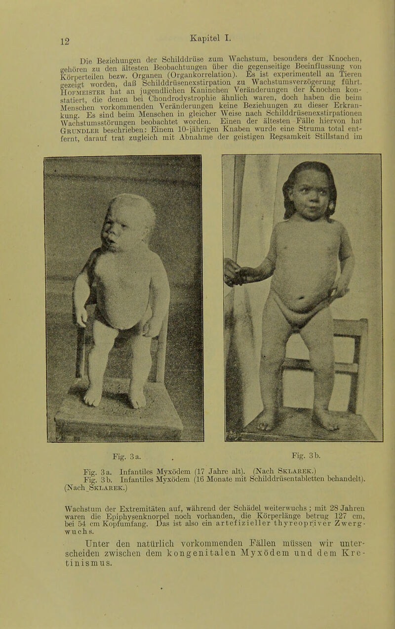 Die Bezieliuiigen der Öchilddfüse zum Wachstum, besondei's der Knochen, gehöreu zu den ältesten Beobachtungen über die gegenseitige Beeinflussung von Körnerteilea bezw. Organen (Organkorrelation). Es ist experimentell an Tieren <rezei-t worden, daß Schilddrüsenexstirpation zu Wachstumsverzögerung führt. fecKMEiSTEU hat an jugendlichen Kaninehen Veränderungen der Knochen kon- statiert, die denen bei Chondrodystrophie ähnlich waren, doch haben die beim Menscii'en vorkommenden Veränderungen keine Beziehungen zu dieser Erkran- kung. Es sind beim Mensehen in gleicher Weise nach Sehilddrüsenexstirpationen Wachstumsstörungen beobachtet worden. Einen der ältesten Fälle liiervon hat Grundler beschrieben: Einem lO-jährigen Knaben wurde eine Struma total ent- fernt, darauf trat zugleich mit Abnahme der geistigen Regsamkeit Stillstand im Fig. 3 a. . Fig. 3 b. Fig. 3 a. Infantües Myxödem (17 Jahre alt). (Nach Sklarek.) Fig. 3 b. Infantiles Myxödem (16 Monate mit Schüddi-üseutabletten behandelt). (Nach Sklakek.) Wachstum der Extremitäten auf, während der Schädel weiterwuchs ; mit 28 Jahren waren die Epiphysenknorpel noch vorhanden, die Körperlänge betrug 127 cm, bei 54 cm Kopfumfang. Das ist also ein artefizieller thyreopriver Zwerg- wuchs. Unter den natürlich vorkommenden Fällen müssen wir unter- scheiden zwischen dem kongenitalen Myxödem und dem Kre- tinismus.