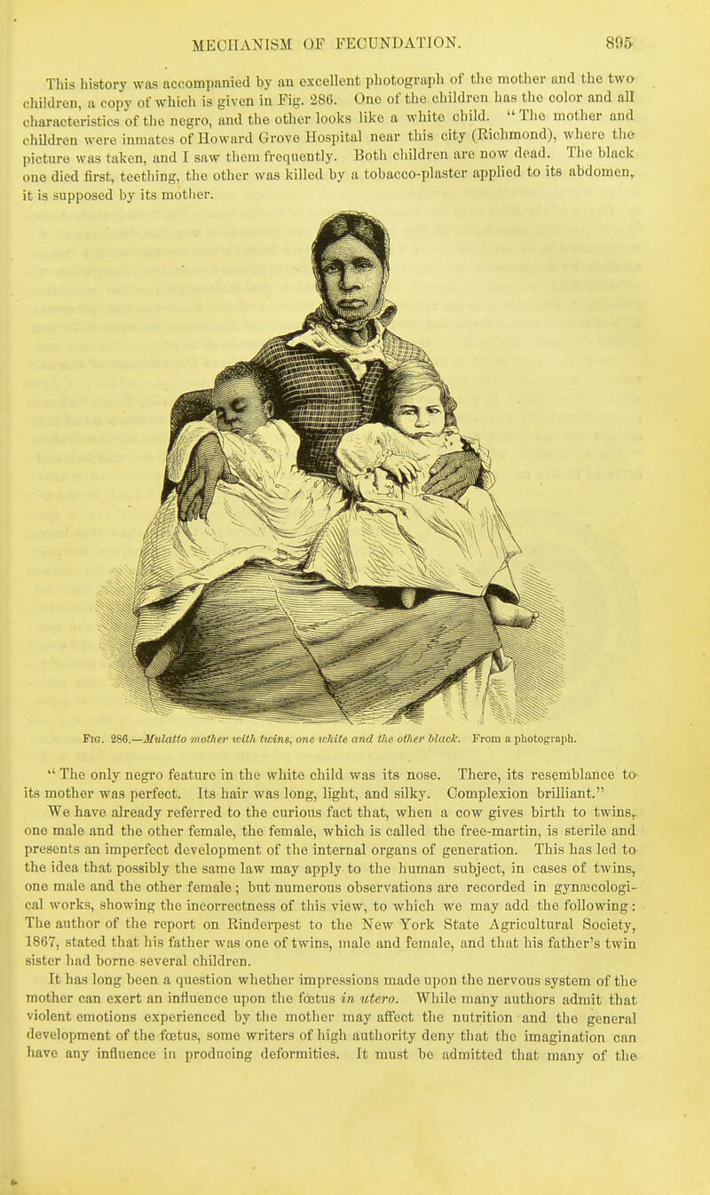 Tliis history was accompanied by an excellent photograph of the mother and the tw» children, a copy of which is given in Eig. 286. One of the children has the color and all characteristics of the negro, and the other looks like a white child.  The mother and children were inmates of Howard Grove Hospital near this city (Kichmond), where the picture was taken, and I saw them frequently. Both cliildren are now dead. The black one died first, teething, the other was killed by a tobacco-plaster applied to its abdomen, it is supposed by its mother. Fig. 286.—Mulatto motJiev uith twins, one white and the other black. From a pbotoffvaph. '' The only negi'o feature in the white child was its nose. There, its resemblance to its mother was perfect. Its hair was long, light, and silky. Complexion brilliant. We have already referred to the curious fact that, when a cow gives birth to twins^ one male and the other female, the female, which is called the free-martin, is sterile and presents an imperfect development of the internal organs of generation. This has led to the idea that possibly the same law may apply to the human subject, in cases of twins, one male and the other female ; but numerous observations are recorded in gyna3Cologi- cal works, showing the incorrectness of this view, to which we may add the following: The author of the report on Rinderpest to the New York State Agricultural Society, 1867, stated that his father was one of twins, male and female, and that his father's twin sister had borne several children. It has long been a question whether impressions made upon the nervous system of the mother can exert an influence upon the foetus in uUto. While many authors admit that violent emotions experienced by the mother may affect the nutrition and the general development of the foetus, some writers of high authority deny that the imagination can have any influence in producing deformities. It must be admitted that many of the