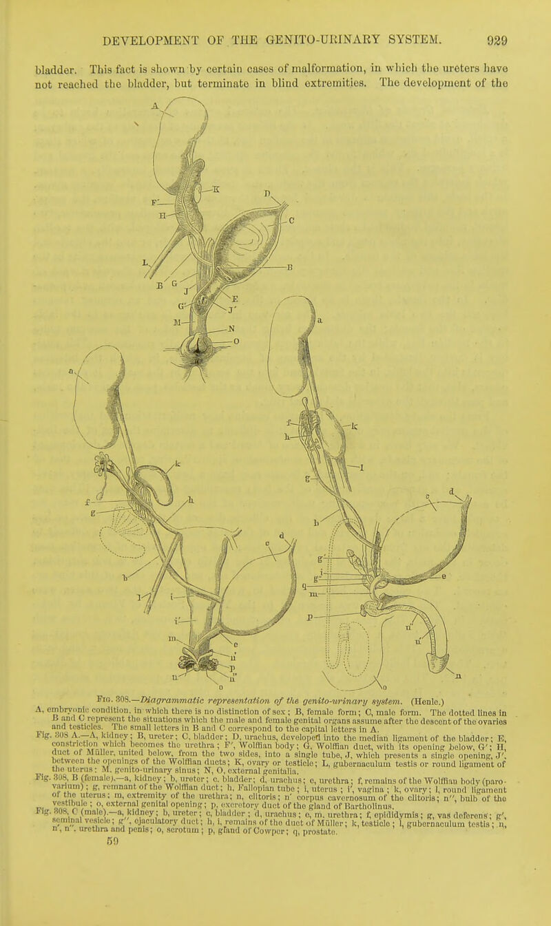 bladder. This fact is shown by certain cases of malformation, in which the ureters have not reached the bladder, but terminate in blind extremities. The development of the Fio. SOS.—Diagrammatic representatioti of the genito-urinary system. (Henlc.) A, embryonic condition, in whicli there is no diRtinction of sex ; B, female form; C, male form. Tlic dotted lines in J ^-''f f'n situations whicti tlio male and female genital organs assume after the descent of the ovaries and testicles. Ihe small letters in B and C correspond to the capital letters in A. Fig. 30S A.—A, kidney; B, ureter; C, bladder; D, uraclius, developetl into the median limmont of the bladder; E, constriction which becomes the urethra ; F', Wolffian body; G, Wolffian duct, with its opening below, G'; H, duct ol Muller, united below, from the two sides, into a single tube, J, which presents a single opening, J', between the openings of the Wolffian ducts; K, ovary or testicle; L, gubernaculum testis or rotmd ligament of the uterus: M. gcnito-urinary sinus; N, O, external genitalia. Fig. 308. B(fcuiale^—a, kidney; b, ureter; c. bladder; d, urachiis; e, urethra; f, remains of the Wolffian bodyCparo- variiim); g, remnant ol the Wolfflan duct; h, I''allopian tube ; i, uterus ; 1', vagina ; k, ovary; I, round ligament 01 the uterus; ra, extremity of the urethra; n, clitoris; n' corpus cavernosum of the clitoris; n, liulb of the IK ono r  • ?• 'P] senital opening; p. excretory duct of the gland of Harthoiinua. i-lg.«08, C (male).—a, kidney; b, ureter; c, bladder ; d, nrachus; e, m. urethra; t, epididymis; g, vas deferens'; g', seminal vesicle; g . ejaculatory duct; h, i, remains of tlio duet of Miillcr; k, testicle ; 1, gubernaculum testis; n, n, n . urethra and penis; o, scrotum ; p, gfand of Cowper; q, prostate 59