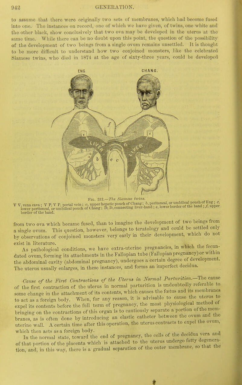 to assume that tlioro wore originally two sets of membranes, which had become fused into one. The instances on record, one of which we have given, of twins, one white and the other black, show conclusively that two ova may he developed in the uterus at the same time. Wliile there can be no doubt upon this point, the question of the ])0S8il)ility of the development of two beings from a single ovum remains unsettled. It is thouglit to be more difficult to understand how two conjoined monsters, like the celebrated Siamese twins, who died in 1874 at the ago of sixty-three years, could be developed ENG. CHANG. Fig 312.—The Siamese twins. VV vena cava - VP VP portal vein; «, upper hepatic pouch of Chang; ^ Peritoneal, or umbilical pouch of E^^^^^ iowe,%Tftoneai; or umbmcal pouch of Ching; D, D, connecting Uver-band ; e, lower border of the band ,/, upper border of the band. from two ova which became fused, than to imagine the development of two beings from a single ovum. This question, however, belongs to teratology and could be settled onlj- by observations of conjoined monsters very early in their development, which do not exist in literature. -u- i ti f As pathological conditions, we have extra-uterine pregnancies, in which the fecun- dated ovum, forming its attachments in the Fallopian tube (Fallopian pregnancy) or within the abdominal cavity (abdominal pregnancy), undergoes a certain degree of development. The uterus usuaUy enlarges, in these instances, and forms an imperfect decidua. Cause of the First Contractions of the Uterus in Normal Farturition.-The cause of the first contraction of the uterus in normal parturition is nndoubtedly referable to some change in the attachment of its contents, which causes the foetus and its membranes to act as a foreign body. When, for any reason, it is advisable to cause the uterus to expel its contents before the full term of pregnancy, the most physiological method ot bringing on the contractions of this organ is to cautiously separate a portion ot the mem- branes, as is often done by introducing an elastic catheter between the ovum and he nterine wall. A certain time after this operation, the uterus contracts to expel the ovum, which then acts as a foreign body. „ , j • i „„,i In the normal state, toward the end of pregnancy, the cells of the decidua vera and of that portion of the placenta which is attached to the uterus undergo f^itty degenera- tion, and, in this way, there is a gradual separation of the outer membrane, so that the