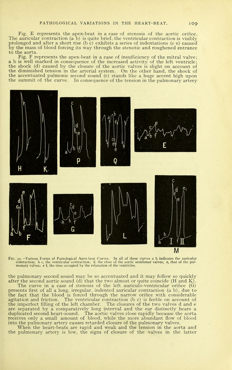 Fig. E represents the apex-beat in a case of stenosis of the aortic orifice. The auricular contraction (a b) is quite brief, the ventricular contraction is visibly prolonged and after a short rise (b c) exhibits a series of indentations (c e) caused by the mass of blood forcing its way through the stenotic and roughened entrance to the aorta. Fig. F represents the apex-beat in a case of insufficiency of the mitral valve; a b is well marked in consequence of the increased activity of the left ventricle;, the shock (d) caused by the closure of the aortic valves is slight on account of the diminished tension in the arterial system. On the other hand, the shock of the accentuated pulmonic second sound (e) stands like a huge accent high upon the summit of the curve. In consequence of the tension in the pulmonary artery the pulmonary second sound may be so accentuated and it may follow so quickly after the second aortic sound (d) that the two almost or quite coincide (H and K). The curve in a case of stenosis of the left auriculo-ventricular orifice (G) presents first of all a long, irregular, indented auricular contraction (a b), due to the fact that the blood is forced through the narrow orifice with considerable agitation and friction. The ventricular contraction (b c) is feeble on account of the imperfect filling of the left chamber. The closures of the two valves d and e are separated by a comparatively long interval and the ear distinctly hears a duplicated second heart-sound. The aortic valves close rapidly because the aorta receives only a small amount of blood, while the more abundant flow of blood into the pulmonary artery causes retarded closure of the pulmonary valves. When the heart-beats are rapid and weak and the tension in the aorta and the pulmonary artery is low, the signs of closure of the valves in the latter
