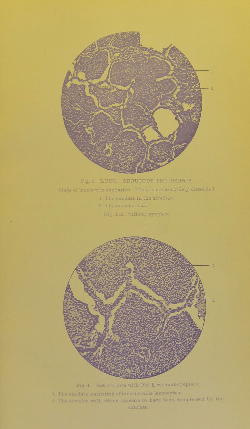 Fig. 3. LUNG. CROUPOUS PNEUMONIA Stage ofleucocytic exudation. The alveoli are widely ( 1. The exudate in the alveolus. 2. The alveolar wall.