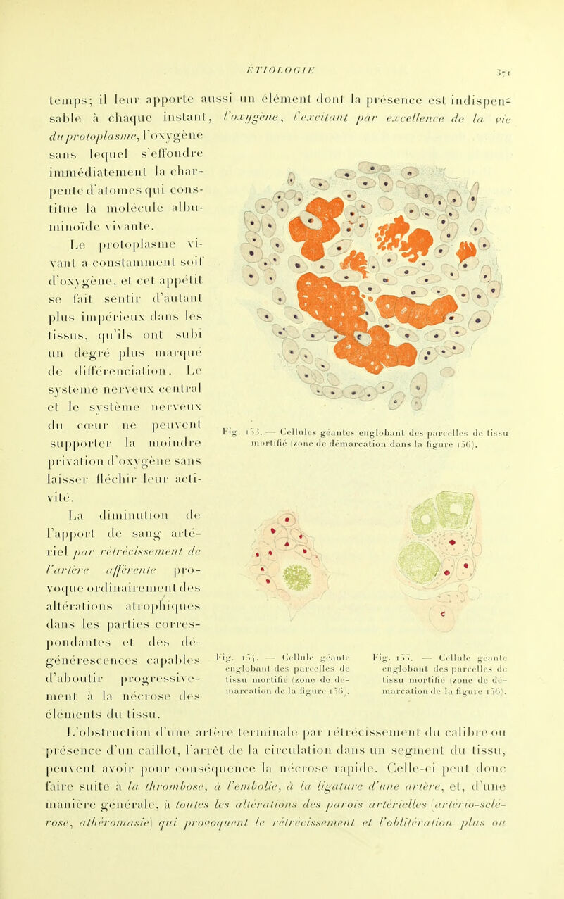 3:1 Vie V). - Cellules géantes engldbaiil des parcelles de lissu iiiorlifié (zone de domorcalioii dans la (i};ure i jfi). temps; il leui- apporte aussi iiii élémeiil doiil la |)i(''sciicc est irulispen- sable à chaque instant, l'o-vi/gène, Ccrciiaiu, par cxceUence de la duproloplasnie, roxygèue sans leciucl s'eiToncli-e immédiatement la eliar- pciile cralomes (|ui (N:)ns- titue la moléfulc alhu- minoïcle vivante. Le pioloplasmc vi- vant a conslaniinenl soit (l'oxygène, el eel ai)|)elil se l'ait seiilii- (ranlaiil ])lus inipt'i-icux dans les tissus, (pTils ont sul)i un degi(' plus iiiai(|U(' de dilléiencialion . \a' système nerveux eenlial et le système nei\eux du cn'ur ne peuveni supporlei- la nM)iiidre privation d'oxygène sans laisser Ih'cliir leur acli- vité. \a\ (liniiiuilion tie Tapporl de sang arté- riel pdr /■('Irccisscniciil de Ciirleri' n Iférc/i h' pro- vo([ue oi'd I lia i icnicn 1 des al[('ral ions alropliicpios dans les pailies eoi ies- j)oii(laii les el des de- généreseenees capal)les d'aboutir progrcssiN c- ment à la ik'cioso des éléments du lissu. J/ol)sli'uelion d'une ailère leriiiiiialo par rc'l réeisseiiieiit du calibre ou [)réseiiee d un caillol, rai rèl de la circulation dans un segmcnl du lissu, peuvent avoir pour consécpience la nécrose rapide. Celle-ci peul donc l'aire suite à la lltraiiihosc, à /'c/u/julic. à Ut li<:itlitrc d'une urù'rc. el, d'une manièi'e générale, à Inulcs les itItrialIons c/c.s- parois urU-rudles ///■//■/■/o-sc/c- 7^os(\ nIlirroni(tsic, tjni pi-osuxjiicnl le ri'lrcciss<'nicnI cl l'olili/crnIion plus on 7 ■il;', i)!.. — Cellule j^'-éauli l'iij^luhaiil dos [)areel!es cl(_ li^su uioi'lillé (zone de dé- nia real imi de la ii  u re i , Fij;'. i,)). — Cellule goanio eiiglobaiil des parcelles de lissu iiiorlllié fzoue de d<'- iuar< al iuu de la figure I )<i\