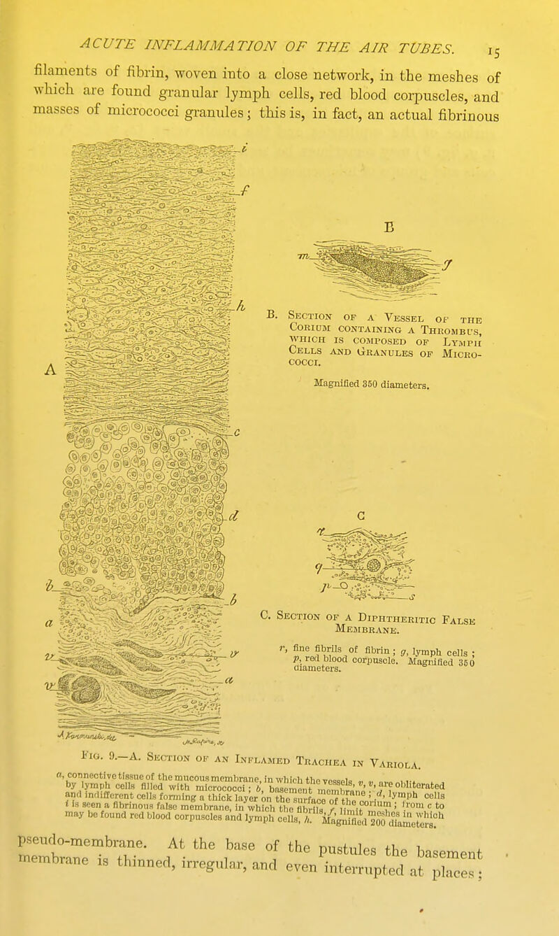 filaments of fibrin, woven into a close network, in the meshes of which are found granular lymph cells, red blood corpuscles, and masses of micrococci granules; this is, in fact, an actual fibrinous B B. Section of a Vessel of the CORIUM CONTAINING A THROMBI'S, WHICH IS COMPOSED OF LyuiPIE Cells and Granules of Micro- cocci. Magnified 350 diameters. C. Section of a Diphtheritic False Membrane. r, fine fibrils of fibrin; g, lymph cells ; p, red blood corpuscle. Magnified 350 diameters. Fig. 9.-A. Section of an Inflamed Trachea in Variola. a, connective tissue of the mucous membrane lnwMdiHn.i«».«i. by lymph cells filled with micrococc? 6, bosemtmemb^n'^'f'? 0l,lit.°rated and indifferent cells forming a thick layer ontheSurface of tw ; i ' •Vlph cel,s toembraue is thinned, irregular, and even interrupted at place.;