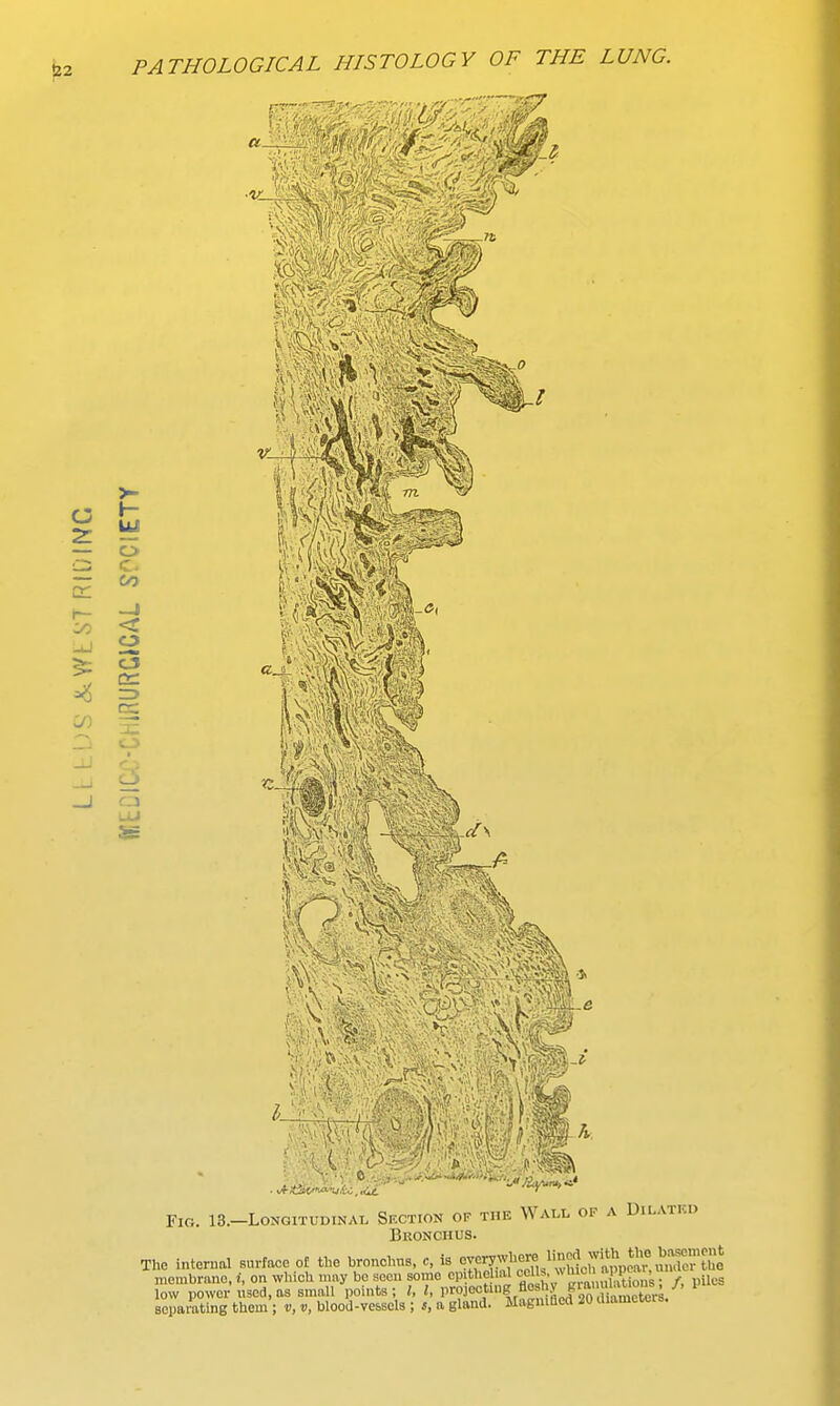 C 2: UJ St CO o c. in < o I #2 lip gf% iHsfcif wasf ^aM .JmS&u&'MT'* ' - Fig. 13.—Longitudinal Section of the Wall of a Dilatkd Bronchus. The internal surface ot the bronchus, e, is jj^^^iffit membrane, i, on whloh may bo seen some epithelial oelbi, w™»Xt^ ; /, piles low power used, as small points; I, I, V«^PtJ^SJfS^SS^n V separating them ; v, v, blood-vessels ; s, a gland. Magnified 20 diameters.