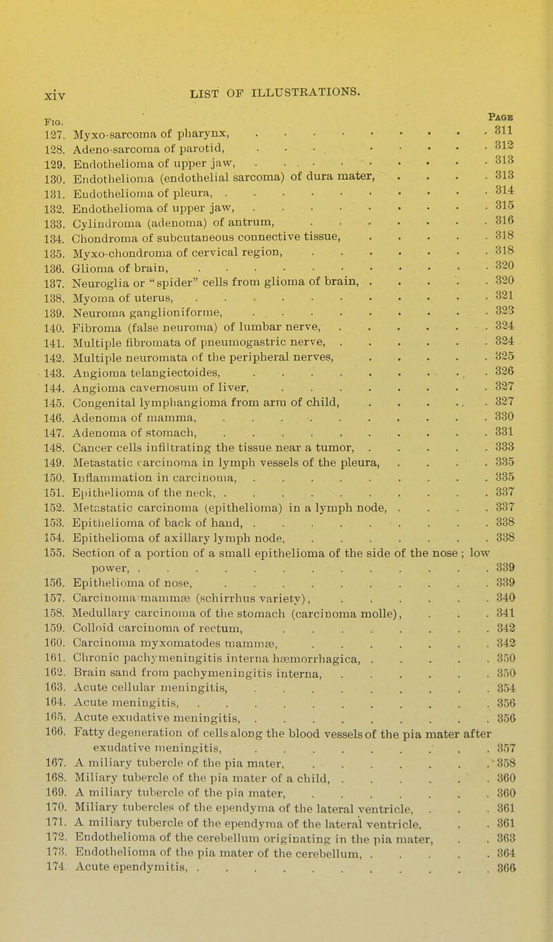 Fig. 127. Myxo-sarcoma of pharynx, 128. Adeuo-sarcoma of parotid, . . • . 129. Endothelioma of upper jaw, . ... • • 130. Endothelioma (endothelial sarcoma) of dura mater, 131. Eudothelioma of pleura, 132. Endothelioma of upper jaw, 133. Cylindroma (adenoma) of antrum, .... 134. Chondroma of subcutaneous connective tissue, 135. Myxo-chondroma of cervical region, .... 136. Glioma of brain, 137. Neuroglia or spider cells from glioma of brain, . 138. Myoma of uterus 139. Neuroma ganglioniforme, 140. Fibroma (false neuroma) of lumbar nerve, 141. Multiple fibromata of pneumogastric nerve, . 143. Multiple neuromata of the peripheral nerves, 143. Angioma telangiectoides, 144. Angioma cavernosum of liver, ..... 145. Congenital lympliangioma from arm of child, 146. Adenoma of mamma, ....... 147. Adenoma of stomach, ....... 148. Cancer cells infiltrating the tissue near a tumor, . 149. Metastatic carcinoma in lymph vessels of the pleura, 150. Inflammation in carcinoma, ...... 151. Epithelioma of the neck, ....... 153. Metastatic carcinoma (epithelioma) in a lymph node, . 153. Epitlielioma of back of hand 154. Epithelioma of axillary lymph node, .... 155. Section of a portion of a small epithelioma of the side of the power 156. Epithelioma of nose, ....... 157. Carcinoma mamma3 (schirrhus variety), 158. Medullary carcinoma of the stomach (carcinoma molle), 159. Colloid carcinomfi of rectum, ..... 160. Carcinoma myxomatodes mammsB, .... 161. Chronic pachymeningitis interna hsemorrhagica, . 163. Brain sand from pachymeningitis interna, 163. Acute cellular meningitis, ...... 164. Acute meningitis, 165. Acute exudative meningitis, ...... 166. Fatty degeiieration of cells along the blood vessels of the pia mater exudative meningitis, ...... 167. A miliary tubercle of the pia mater, .... 168. Miliary tubercle of the pia mater of a child, . 169. A miliary tubercle of the pia mater, .... 170. Miliary tubercles of the ependyma of the lateral ventricle, 171. A miliary tubercle of the ependyma of the lateral ventricle, 172. Endothelioma of the cerebellum originating in the pia mater 178. Endothelioma of the pia mater of the cerebellum, . 174. Acute ependymitis, nose Page . 311 . 312 . 313 . 313 . 314 . 315 low after . 357 .358 . 360 . 360 . 361 . 361 . 363 . 364 . 366