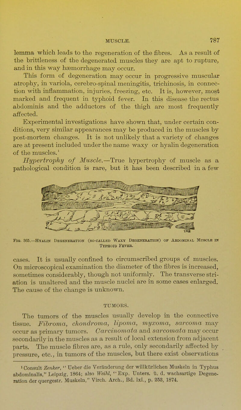 lemma which leads to the regeneration of the fibres. As a result of the brittleness of the degenerated muscles they are apt to rupture, and in this way haemorrhage may occur. This form of degeneration may occur in progressive muscular atrophy, in vai'iola, cerebro-spinal meningitis, trichinosis, in connec- tion with inflammation, injuries, freezing, etc. It is, however, most marked and frequent in typhoid fever. In this disease the rectus abdominis and the adductors of the thigh are most frequently affected. Experimental investigations have shown that, under certain con- ditions, very similar appearances may be produced in the muscles by post-mortem changes. It is not unlikely that a variety of changes are at present included under the name waxy or hyalin degeneration of the muscles.' Hypertrophy of Muscle.—True hypertrophy of muscle as a pathological condition is rare, but it has been described in a few Flo. 365.—Hyalin DKomBBATioN (so-called Waxy Degkneration) op Abdominal Musolk in Typhoid Fbvbb. cases. It is usually confined to circumscribed groups of muscles. On microscopical examination the diameter of the fibres is increased, sometimes considerably, though not uniformly. The transverse stri- ation is unaltered and the muscle nuclei are in some cases enlarged. The cause of the change is unknown. TUMORS. The tumors of the muscles usually develop in the connective tissue. Fibroma, chondroma, lipoma, myxoma, sarcoma may occur as primary tumors. Carcinoinata and sarcomata may occur secondarily in the muscles as a result of local extension from adjacent parts. The muscle fibres are, as a rule, only secondarily affected by pressure, etc., in tumors of the muscles, but there exist observations I Consult Zenker,  Ueber die Verttnderung der willkllrlichen Muskeln in Typhus abdominalis, Leipzig, 1864; also Weihl, Exp. Unters. U. d. wachsartige Degene- ration der quergestr. Muskeln, Virch. Arcli., Bd. Ixi., p. 258, 1874.