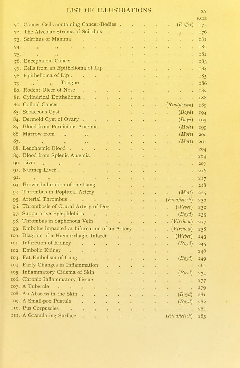 I'AGE 71. Cancer-Cells containing Cancer-Bodies (Riiffei ) 175 72. The Alveolar Stroma of Scirrhus 176 73. Scirrhus of Mamma 181 74- .. 182 75-  182 76. Encephaloid Cancer 183 77. Cells from an Epithelioma of Lip ........ 184 78. Epithelioma of Lip 185 79- .. - Tongue 186 80. Rodent Ulcer of Nose 187 81. Cylindrical Epithelioma 188 82. Colloid Cancer (RiiidJIeisch) 189 83. Sebaceous Cyst (Boyd) 194 84. Dermoid Cyst of Ovary (Boyd) 195 85. Blood from Pernicious Anaemia (Mott) 199 86. Marrow from ,, ,, (Mott) 200 87. ,, ,, ,, (Mott) 201 88. Leuchaemic Blood 204 89. Blood from Splenic Anaemia 204 90. Liver ,, ,, ,, 207 91. Nutmeg Liver 216 92 217 93. Brown Induration of the Lung 218 94. Thrombus in Popliteal Artery (Mott) 225 95. Arterial Thrombus (Rindfleisch) 230 95. Thrombosis of Crural Artery of Dog (Weber) 232 97. Suppurative Pylephlebitis . . (Boyd) 235 98. Thrombus in Saphenous Vein (Virchow) 237 99. Embolus impacted at bifurcation of an Artery . . . (Virchoiv) 238 100. Diagram of a Hsemorrhagic Infarct (Weber) 243 101. Infarction of Kidney (Boyd) 245 102. Embolic Kidney ........... 246 103. Fat-Embolism of Lung (Boyd) 249 104. Early Changes in Inflammation 264 105. Inflammatory CEdema of Skin (Boyd) 274 106. Chronic Inflammatory Tissue 277 107. A Tubercle 279 108. An Abscess in the Skin (Boyd) 281 109. A Small-pox Pustule (Boyd) 282 110. Pus Corpuscles 284 111. A Granulating Surface ...... . . (Rindfleisch) 285