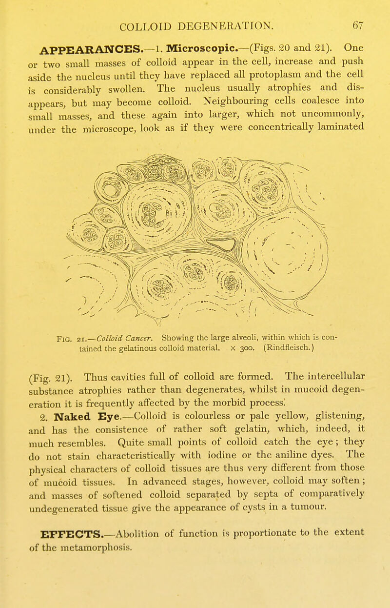 APPEARANCES.—1. Microscopic—(Figs. 20 and 21). One or two small masses of colloid appear in the cell, increase and push aside the nucleus until they have replaced all protoplasm and the cell is considerably swollen. The nucleus usually atrophies and dis- appears, but may become colloid. Neighbouring cells coalesce into small masses, and these again into larger, which not uncommonly, under the microscope, look as if they were concentrically laminated Fig. 21.—Colloid Cancer. Showing the large alveoH, within which is con- tained the gelatinous colloid material. X 300. (Rindfleisch.) (Fig. 21). Thus cavities full of colloid are formed. The intercellular substance atrophies rather than degenerates, whilst in mucoid degen- eration it is frequently affected by the morbid process! 2. Naked Eye.—Colloid is colourless or pale yellow, glistening, and has the consistence of rather soft gelatin, which, indeed, it much resembles. Quite small points of colloid catch the eye; thqy do not stain characteristically with iodine or the aniline dyes. The physical characters of colloid tissues are thus very different from those of mucoid tissues. In advanced stages, howevei-, colloid may soften; and masses of softened colloid separated by septa of comparatively undegenerated tissue give the appearance of cysts in a tumour. EFFECTS.—Abolition of function is proportionate to the extent of the metamorphosis.