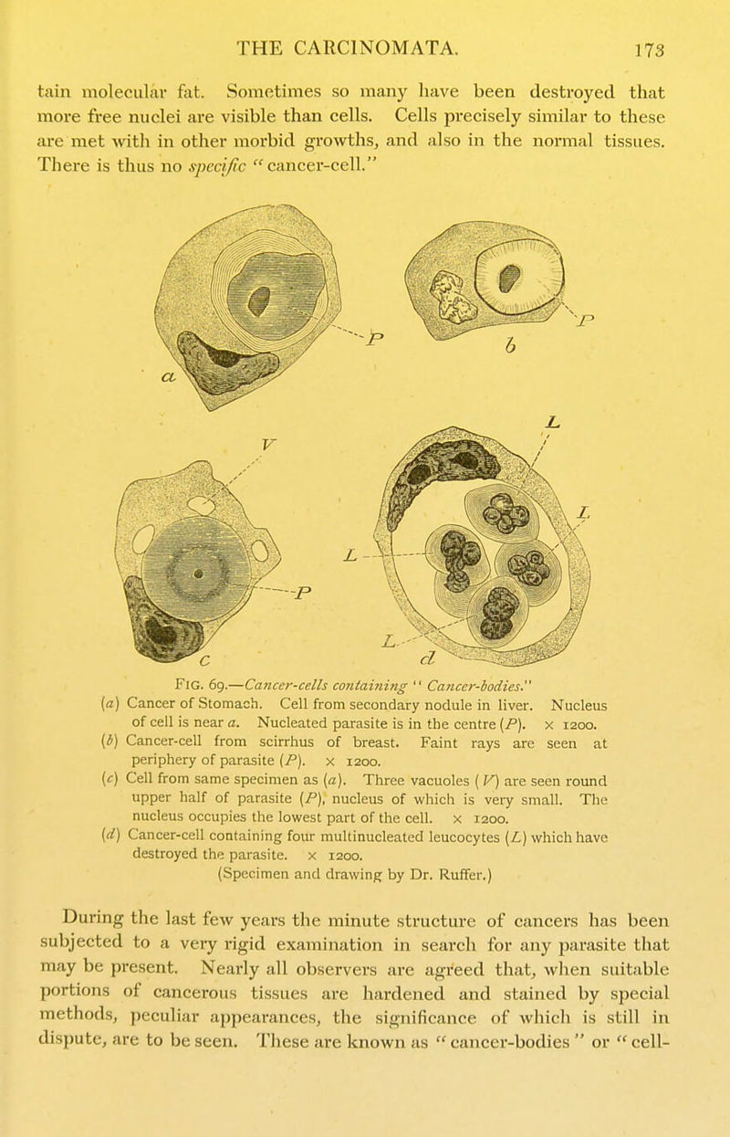 tain molecuLar fot. Sometimes so many have been desti-oyetl that more free nuclei are visible than cells. Cells precisely similar to these are met with in other morbid growths, and also in the normal tissues. There is thus no sj)eci/ic cancer-cell. Fig. 69.—Cancef-cells containing  Cancer-bodies. (a) Cancer of Stomach. Cell from secondary nodule in liver. Nucleus of cell is near a. Nucleated parasite is in the centre [P). x 1200. {b) Cancer-cell from scirrhus of breast. Faint rays are seen at periphery of parasite (P). x 1200. (c) Cell from same specimen as (a). Three vacuoles ( V) are seen roiuid upper half of parasite {P), nucleus of which is very small. The nucleus occupies the lowest part of the cell, x 1200. (d) Cancer-cell containing four multinucleated leucocytes {L) which have destroyed the parasite, x 1200. (Specimen and drawing by Dr. Ruffer.) During the last few years the minute structure of cancers has been subjected to a very rigid examination in search for any jDarasite that may be present. Nearly all observers are agreed that, when suitable portions of cancerous tissues are hardened and stained by special methods, peculiar appearances, the significance of which is still in dispute, are to be seen. These are known as  cancer-bodies  or  cell-