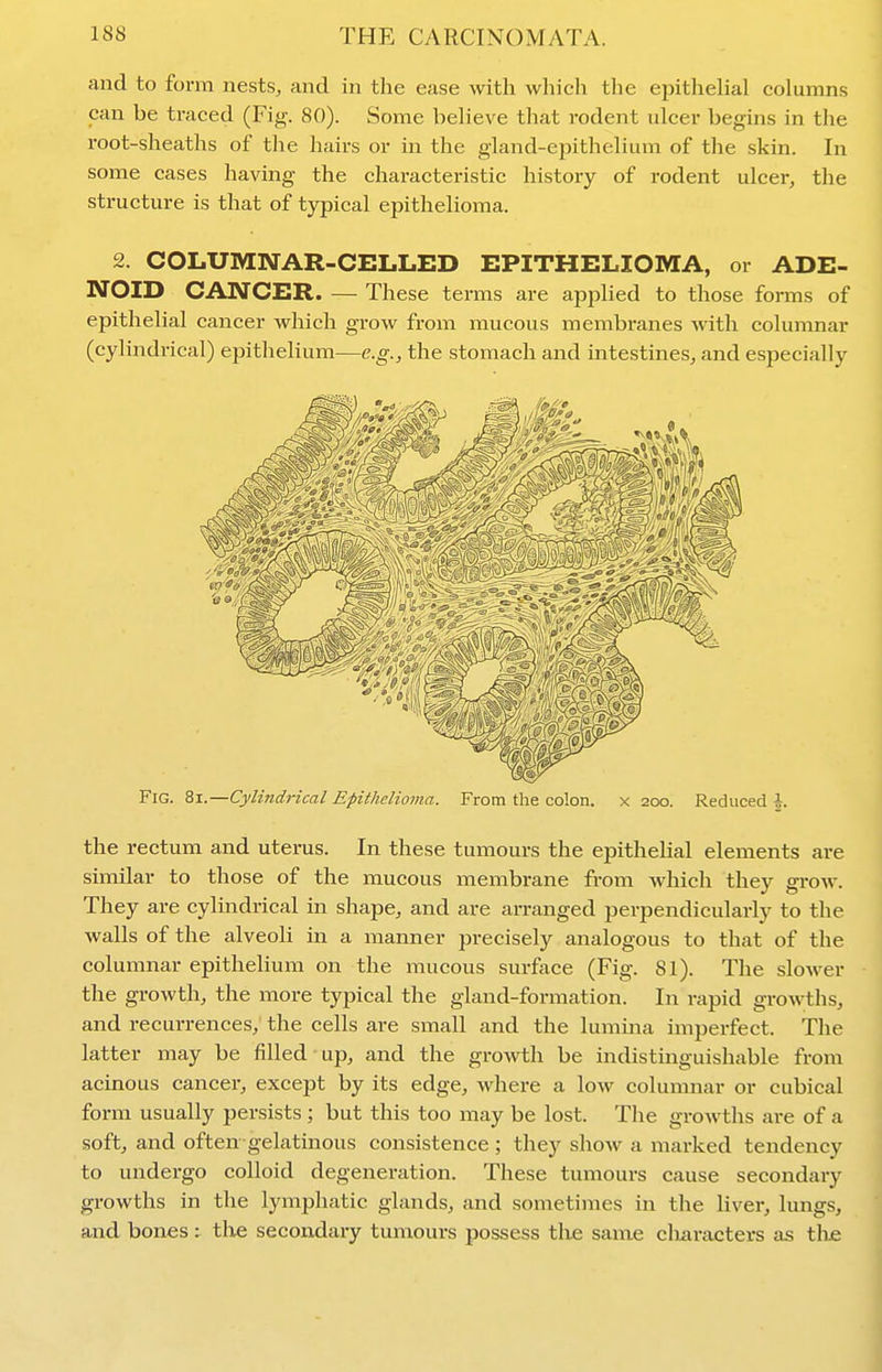 and to form nests, and in the ease with which the epithelial columns can be traced (Fig. 80). Some believe that rodent ulcer begins in the root-sheaths of the hairs or in the gland-epithelium of the skin. In some cases having the characteristic history of rodent ulcer, the structure is that of typical epithelioma. 2. COLUMNAR-CELLED EPITHELIOMA, or ADE- NOID CANCER These terms are applied to those forms of epithelial cancer which grow from mucous membranes with columnar (cylindrical) epithelium—e.g., the stomach and intestines, and especially Fig. 8i.—Cylindrical Epitlielioma. From the colon, x 200. Reduced \. the rectum and uterus. In these tumours the epithelial elements are similar to those of the mucous membrane from Avhich they grow. They are cylindrical in shape, and are amanged perpendicularly to the walls of the alveoli in a manner precisely analogous to that of the columnar epithelium on the mucous surface (Fig. 81). The slower the growth, the more typical the gland-formation. In rapid growths, and recurrences, the cells are small and the lumma imperfect. The latter may be filled up, and the growth be indistmguishable from acinous cancer, except by its edge, where a low columnar or cubical form usually persists ; but this too may be lost. The growths are of a soft, and often gelatinous consistence ; they show a marked tendency to undergo colloid degeneration. These tumours cause secondary growths in the lymphatic glands, and sometimes in the liver, lungs, and bones : tlie secondary tumours possess tlie same cliaracters as the