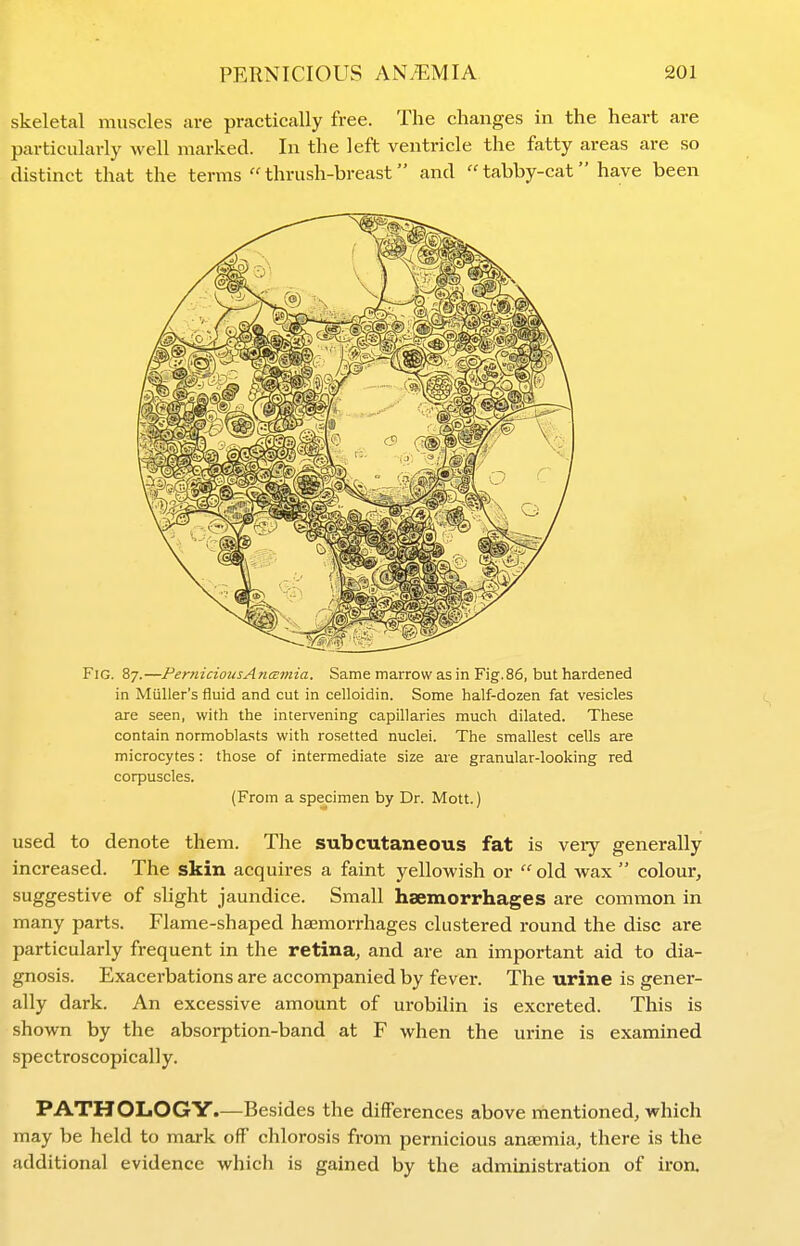 skeletal muscles are practically free. The changes in the heart are particularly well marked. In the left ventricle the fatty areas are so distinct that the terms thrush-breast and tabby-cat have been Fig. 87.—PerniciousAncB7nia. Same marrow as in Fig.86, but hardened in Miiller's fluid and cut in celloidin. Some half-dozen fat vesicles are seen, with the intervening capillaries much dilated. These contain normoblasts with resetted nuclei. The smallest cells are microcytes: those of intermediate size are granular-looking red corpuscles. (From a specimen by Dr. Mott.) used to denote them. The subcutaneous fat is veiy generally- increased. The skin acquires a faint yellowish or old wax  colour, suggestive of slight jaundice. Small haemorrhages are common in many parts. Flame-shaped haemorrhages clustered round the disc are particularly frequent in the retina, and are an important aid to dia- gnosis. Exacerbations are accompanied by fever. The urine is gener- ally dark. An excessive amount of urobilin is excreted. This is shown by the absorption-band at F when the urine is examined spectroscopically. PATHOLOGY.—Besides the differences above mentioned, which may be held to mark off chlorosis from pernicious anaemia, there is the additional evidence which is gained by the administration of iron.