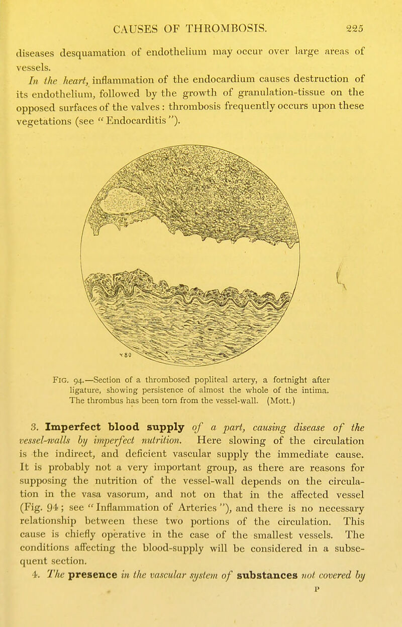 diseases desquanication of endothelium may occur over large areas of vessels. In the heart, inflammation of the endocardium causes destruction of its endothelium, followed by the growth of granulation-tissue on the opposed surfaces of the valves : thrombosis frequently occurs upon these vegetations (see Endocarditis). Fig. 94.—Section of a thrombosed popliteal artery, a fortnight after ligature, showing persistence of almost the whole of the intima. The thrombus has been torn from the vessel-wall. (Mott.) 3. Imperfect blood supply of a j)art, causing disease of the vessel-walls hy imperfect nutrition. Here slowing of the circulation is the indirect, and deficient vascular supply the immediate cause. It is probably not a very important group, as there are reasons for supposing the nutrition of the vessel-wall depends on the circula- tion in the vasa vasorum, and not on that in the affected vessel (Fig. 94 ; see  Inflammation of Arteries ), and there is no necessary relationship between these two portions of the circulation. This cause is chiefly operative in the case of the smallest vessels. The conditions affecting the blood-supply will be considered in a subse- quent section. 4. The presence in the vascular system of substances not covered hy p