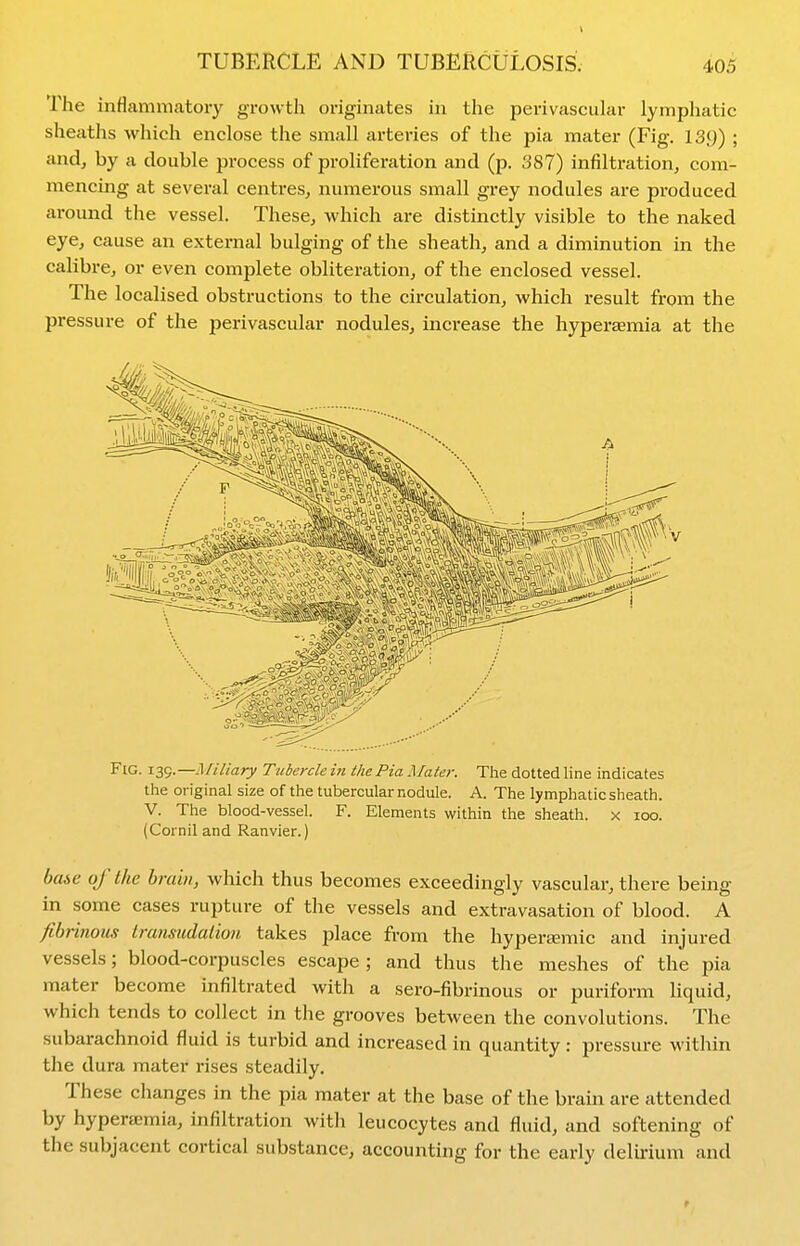 V TUBERCLE AND TUBERCULOSIS. 405 The inflammatory growth originates in the pei-ivascular lymphatic sheaths which enclose the small arteries of the pia mater (Fig. 139) ; and, by a double process of proliferation and (p. 387) infiltration, com- mencing at several centres, numerous small grey nodules are produced around the vessel. These, which are distinctly visible to the naked eye, cause an external bulging of the sheath, and a diminution in the calibre, or even complete obliteration, of the enclosed vessel. The localised obstructions to the circulation, which result from the pressure of the perivascular nodules, increase the hypersemia at the Fig. Miliary Tubercle in the Pia Mater. The dotted line indicates the original size of the tubercular nodule. A. The lymphatic sheath. V. The blood-vessel. F. Elements within the sheath, x loo. (Cornil and Ranvier.) baie of the brain, which thus becomes exceedingly vascular, there being in some cases rupture of the vessels and extravasation of blood. A fibrinous transudation takes place from the hypertEmic and injured vessels; blood-corpuscles escape ; and thus the meshes of the pia mater become infiltrated with a sero-fibrinous or puriform hquid, which tends to collect in the grooves between the convolutions. The subarachnoid fluid is turbid and increased in quantity : pressure within the dura mater rises steadily. These changes in the pia mater at the base of the brain are attended by hyperaemia, infiltration with leucocytes and fluid, and softening of the subjacent cortical substance, accounting for the early delirium and