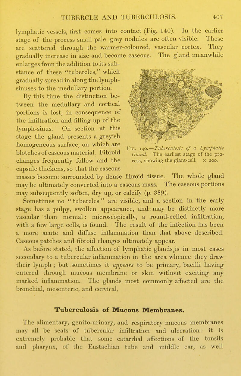 lymphatic vessels, first comes into contact (Fig. 140). In the earlier stage of the process small pale grey nodules are often visible. These are scattered through the warmer-coloured, vascular cortex. They gradually increase in size and become caseous. The gland meanwhile enlarges from the addition to its sub- stance of these tubercles, which gradually spread in along the lymph- sinuses to the medullary portion. By this time the distinction be- tween the medullaiy and cortical portions is lost, in consequence of the infiltration and filling up of the lymph-sinus. On section at this stage the gland presents a greyish homogeneous surface, on which are blotches of caseous material. Fibroid changes frequently follow and the capsule thickens, so that the caseous masses become surrounded by dense fibroid tissue. The whole gland may be ultimately converted into a caseous mass. The caseous portions may subsequently soften, dry up, or calcify (p. 389). Sometimes no  tubercles  are visible, and a section in the early stage has a pulpy, swollen appearance, and may be distinctly more vascular than normal: microscopically, a round-celled infiltration, with a few large cells, is found. The result of the infection has been a more acute and diffuse inflammation than that above described. Caseous patches and fibioid changes ultimately appear. As before stated, the affection of lymphatic glands.is in most cases secondary to a tubercular inflammation in the area whence they draw their lymph ; but sometimes it appears to be primary, bacilli having entered through mucous membrane or skin without exciting any marked inflammation. The glands most commonly affected are the bronchial, mesenteric, and cervical. Tuberculosis of Mucous Membranes. The alimentary, genito-urinary, and respiratory mucous membranes may all be seats of tubercular infiltration and ulceration: it is extremely probable that some catarrhal affections of the tonsils and phaiynx, of the Eustachian tube and middle ear, as well Fig. 140.—Tuberculosis of a Lymphatic Gland. The earliest stage of the pro- cess, showing the giant-cell, x 200.