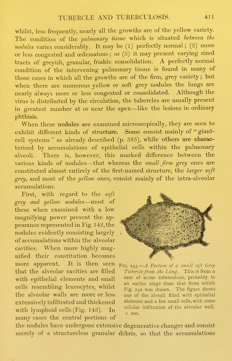 whilst, less frequently, nearly all the growths are of the yellow variety. The condition of the jmlmonart/ tissue which is situated between the nodules varies considerably. It may be (1) perfectly normal; (2) more or less congested and oedematous; or (3) it may present varying sized tracts of greyish, granular, friable consolidation. A perfectly normal condition of the intervening pulmonary tissue is found in many of those cases in which all the growths are of the firm, grey variety; but when there are numerous yellow or soft grey nodules the lungs are nearly always more or less congested or consolidated. Although the virus is distributed by the circulation, the tubercles are usually present in greatest number at or near the apex—Uke the lesions in ordinary phthisis. When these nodules are examined microscopically, they are seen to exhibit different kinds of structure. Some consist mainly of  giant- cell systems  as already described (p. 385), while others are charac- terised by accumulations of epithelial cells within the pulmonary alveoU. There is, however, this marked difference between the various kinds of nodules—that whereas the small firm grey ones are constituted almost entnely of the first-named structure, the larger soft grey, and most of the yellow ones, consist mainly of the intra-alveolar accumulations. First, with regard to the soft grey aud yellow nodules—^most of these when examined with a low magnifying power present the ap- pearance represented in Fig. 142, the nodules evidently consisting largely of accumulations within the alveolar cavities. When more highly mag- nified their constitution becomes more apparent. It is then seen y\c. 143 that the alveolar cavities are filled with epithelial elements and small cells resembling leucocytes, whilst the alveolar walls are more or less extensively infiltrated and thickened with lymphoid cells (Fig. 143). In many cases the central portions of the nodules have undergone extensive degenerative changes and consist merely of a structureless granular debris, so that the accumulations A Portion of a small soft Grey Tubercle from the Liuig. This is from a case of acute tuberculosis, probably in an earlier stage than that from which Fig. 142 was drawn. The figure shows one of the alveoli filled with epithelial elements and a few small cells, with some cellular infiltration of the alveolar wall. X 200.