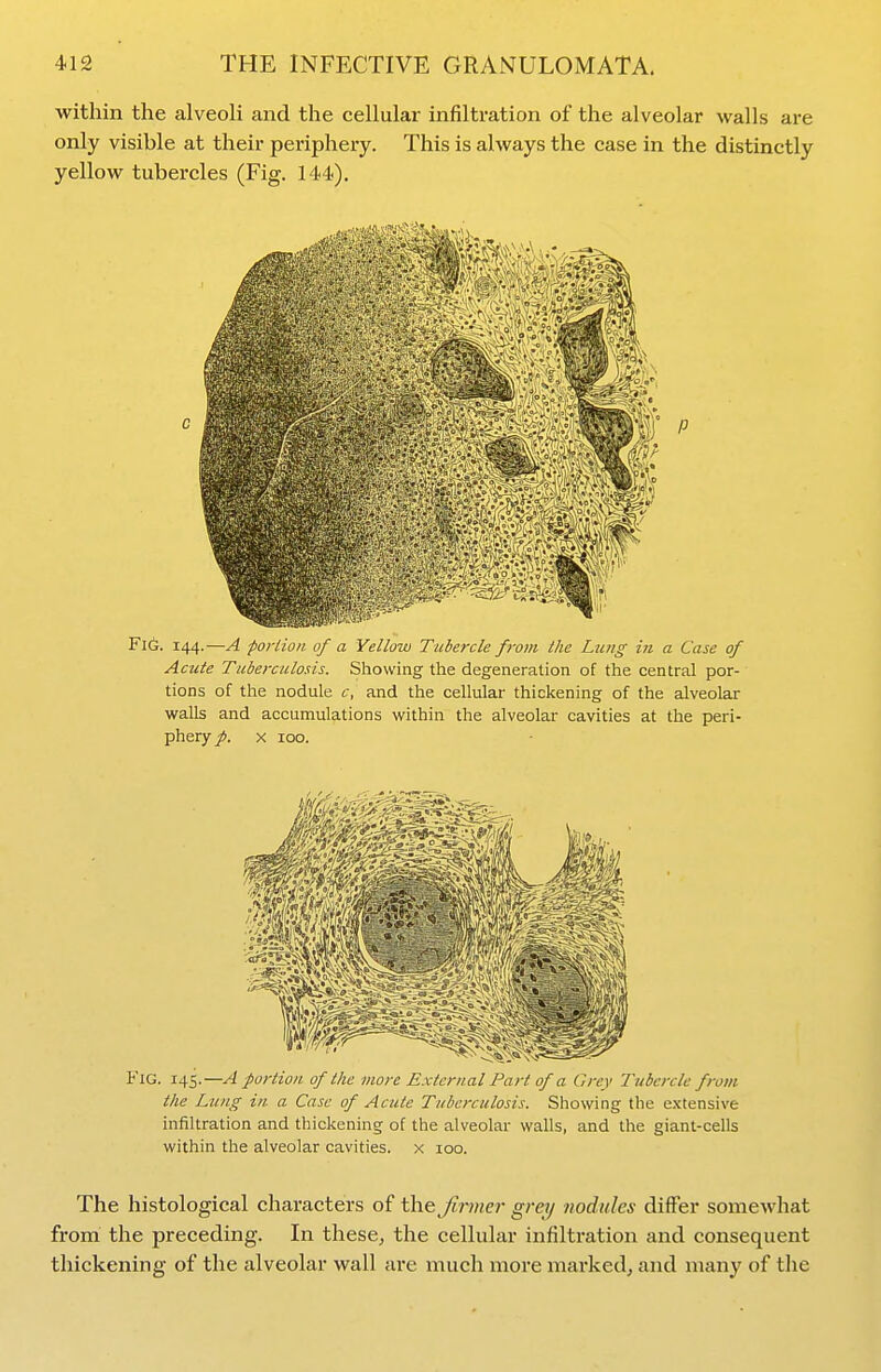 within the alveoli and the cellular infiltration of the alveolar walls are only visible at their periphery. This is always the case in the distinctly yellow tubercles (Fig. 144). Fl6. 144.—A portion of a Yellow Tubercle from the Lung in a Case of Acute Tuberculosis. Showing the degeneration of the central por- tions of the nodule c, and the cellular thickening of the alveolar walls and accumulations within the alveolar cavities at the peri- phery/. X 100. Fig. 145.—A portion of the more External Part of a Grey Tubercle from the Lung in a Case of Acute Tuberculosis. Showing the extensive infiltration and thickening of the alveolar walls, and the giant-cells within the alveolar cavities, x 100. The histological characters of the firmer grey nodules differ somewhat from the preceding. In these, the cellular infiltration and consequent thickening of the alveolar wall are much more mai'ked, and many of the