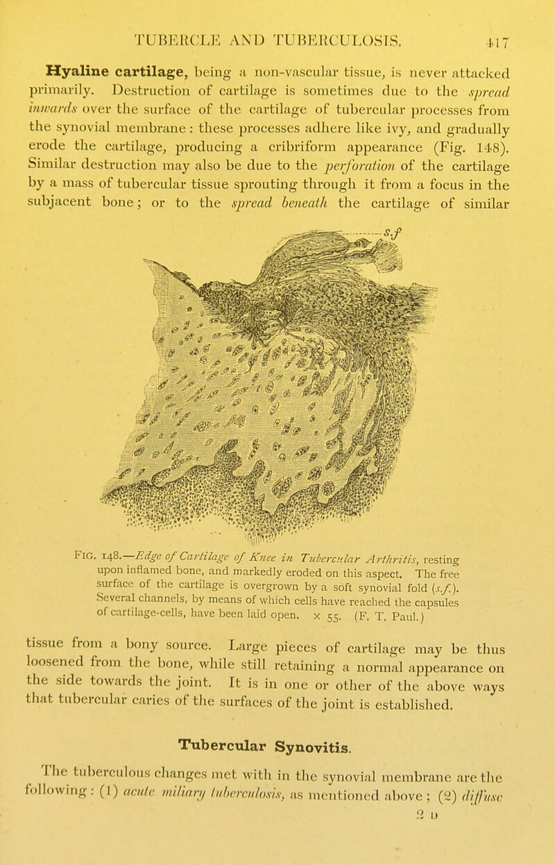 Hyaline cartilage, being n non-vjisciilar tissue, is never attacked primarily. Destruction of cartilage is sometimes clue to the spread inwards over the surface of the cartilage of tubercular pi-ocesses from the synovial membrane: these processes adhere like ivy, and gradually erode the cartilage, producing a cribriform appearance (Fig. 148). Similar destruction may also be due to the perforation of the cartilage by a mass of tubei'cular tissue sprouting through it from a focus in the subjacent bone; or to the spread beneath the cartilage of similar Fig. \a,Z.—Edge of Carlilagc of Knee in Tubercular Arthritis, resting upon inflamed bone, and markedly eroded on this aspect. The free surface of the cartilage is overgrown by a soft synovial fold {s.f). .Several channels, by means of which cells have reached the capsules of cartilage-cells, have been laid open, x 55. (F. T. Paul.) tissue from a bony source. Large pieces of cartilage may be thus loosened from the bone, while still retaining a normal appearance on the side towards the joint. It is in one or other of the above ways that tubercular caries of the surfaces of the joint is established. Tubercular Synovitis. The tuberculous changes met with in the synovial membrane are the following: (1) aculc miliarij liiherculosis, as mentioned above ; (a) di{]'iisv.