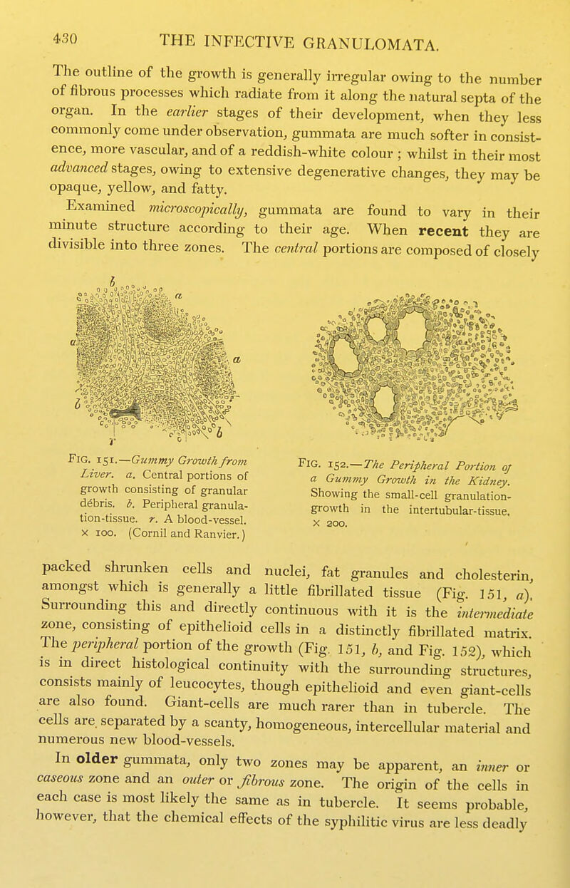 The outline of the growth is generally irregular owing to the number of fibrous processes which radiate from it along the natural septa of the organ. In the earlier stages of their development, when they less commonly come under observation, gummata are much softer inconsist- ence, more vascular, and of a reddish-white colour ; whilst in their most advanced stages, owing to extensive degenerative changes, they may be opaque, yellow, and fatty. Examined microscopically, gummata are found to vary in their minute structure according to their age. When recent they are divisible into three zones. The central portions are composed of closely Fig. 151.—Gummy Growth from Liver, a. Central portions of growth consisting of granular debris, b. Peripheral granula- tion-tissue, r. A blood-vessel. X 100. (Cornil and Ranvier.) Fig. x^2..—The Peripheral Portion oj a Gummy Growth in the Kidney. Showing the small-cell granulation- growth in the intertubular-tissue. X 200. packed shrunken cells and nuclei, fat granules and cholesterin, amongst which is generally a little fibrillated tissue (Fig. 151 a) Surrounding this and directly continuous with it is the intermediate zone, consisting of epithelioid cells in a distinctly fibrillated matrix The peripheral portion of the growth (Fig, 151, h, and Fig. 152), which IS m direct histological continuity with the surrounding structures, consists mainly of leucocytes, though epithelioid and even giant-cells are also found. Giant-cells are much rarer than in tubercle The cells are. separated by a scanty, homogeneous, intercellular material and numerous new blood-vessels. In older gummata, only two zones may be apparent, an inner or caseous zone and an outer or fibrous zone. The origin of the cells in each case is most likely the same as in tubercle. It seems probable, however, that the chemical effects of the syphilitic virus are less deadly