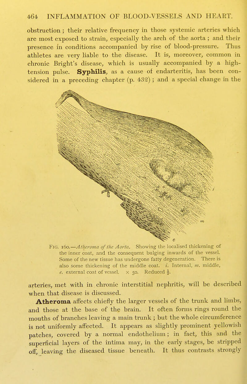 obstruction ; their relative frequency in those systemic arteries which are most exposed to strain, especially the arch of the aorta; and their presence in conditions accompanied by rise of blood-pressure. Thus athletes are very liable to the disease. It is, moreover, common in chronic Bright's disease, which is usually accompanied by a higli- tension pulse. Syphilis, as a cause of endarteritis, has been con- sidered in a preceding chapter (p. 432); and a special change in the Fig. i6o.—At/feroma of the Aorta. Showing the localised thickening of the inner coat, and the consequent bulging inwards of the vessel. Some of the new tissue has undergone fatty degeneration. There is also some thickening of the middle coat. i. Internal, in. middle, e. external coat of vessel, x 50. Reduced \. arteries, met with in chronic interstitial nephritis, will be described when that disease is discussed. Atheroma affects chiefly the larger vessels of the trunk and limbs, and those at the base of the brain. It often forms rings round tlie mouths of branches leaving a main trunk ; but the whole circumference is not uniformly affected. It appears as slightly prominent yellowish patches, covered by a normal endothelium; in fact, this and the superficial layers of the intima may, in the early stages, be stripped off, leaving the diseased tissue beneath. It thus contrasts strongly