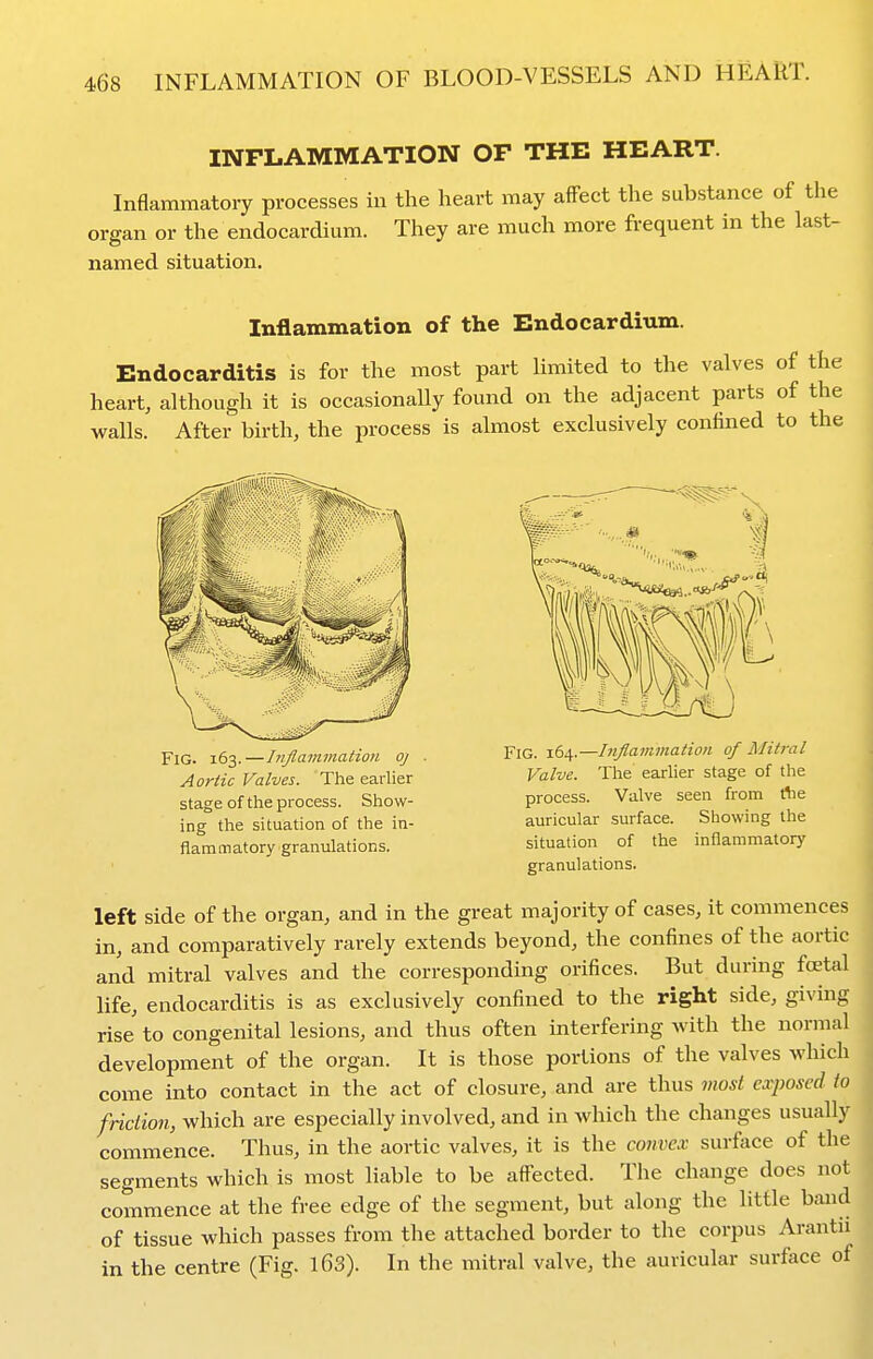 INFLAMMATION OF THE HEART. Inflammatory processes in the heart may afFect the substance of the organ or the endocardium. They are much more frequent in the last- named situation. Inflammation of the Endocardium. Endocarditis is for the most part Umited to the valves of the heart, although it is occasionaUy found on the adjacent parts of the walls. After birth, the process is almost exclusively confined to the Fig. 163.—Inflammation oj Aortic Valves. The earlier stage of the process. Show- ing the situation of the in- flammatory granulations. Fig. 164.—Inflammatioti of Mitral Valve. The earlier stage of the process. Valve seen from tiie auricular surface. Showing the situation of the inflanimator)' granulations. left side of the organ, and in the great majority of cases, it commences in, and comparatively rarely extends beyond, the confines of the aortic and mitral valves and the corresponding orifices. But during fcetal life, endocarditis is as exclusively confined to the right side, giving rise to congenital lesions, and thus often interfering M'ith the normal development of the organ. It is those portions of the valves which come into contact in the act of closure, and are thus most eximscd io friction, which are especially involved, and in which the changes usually commence. Thus, in the aortic valves, it is the convex surface of the segments which is most liable to be affected. The change does not commence at the free edge of the segment, but along the little ban of tissue which passes from the attached border to the corpus Arant in the centre (Fig. l63). In the mitral valve, the auricular surface o