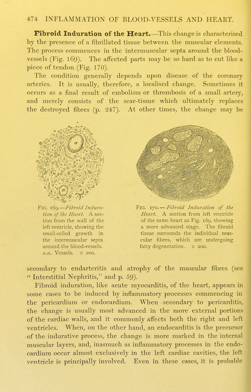 Fibroid Induration of the Heart.—This change is characterised by the presence of a fibrillated tissue between the muscular elements. The process commences in the intermuscular septa around the blood- vessels (Fig. 169). The affected parts may be so hard as to cut like a piece of tendon (Fig. 170). The condition generally depends upon disease of the coronary arteries. It is usually, therefore, a localised change. Sometimes it occurs as a final result of embolism or thrombosis of a small artery, and merely consists of the scar-tissue which ultimately replaces the destroyed fibres (p. 247). At other times, the change may be Fig. 169.—Fibrnid Indura- tion of the Heart. A sec- tion from the wall of the left ventricle, showing the small-celled growth in the intermuscular septa around the blood-vessels. a.a. Vessels, x 200. Fig. 170. — Fibroid Induration of the Heart. A section from left ventricle of the same heart as Fig. 169, showing a more advanced stage. The fibroid tissue surrounds the individual mus- cular fibres, which are undergoing fatty degeneration, x 200. secondary to endarteritis and atrophy of the muscular fibres (see  Interstitial Nephritis, and p. 59). Fibroid induration, like acute myocarditis, of the heart, appears in some cases to be induced by inflammatory processes commencing in the pericardium or endocardium. When secondary to pericarditis, the change is usually most advanced in the more external portions of the cardiac walls, and it commonly affects both the right and left ventricles. When, on the other hand, an endocarditis is the precursor of the indurative process, the change is more marked in the internal muscular layers, and, inasmuch as inflammatory processes in the endo- cardium occur almost exclusively in the left cardiac cavities, the left ventricle is principally involved. Even in these cases, it is probable