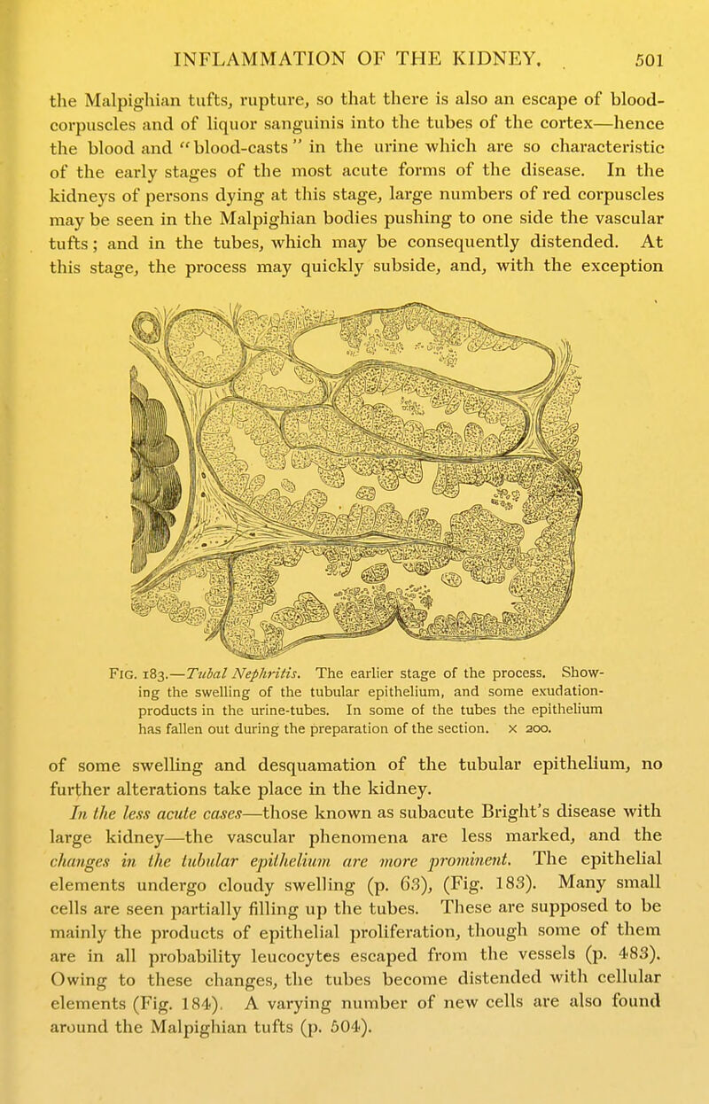 the Malpigliian tuftSj rupture, so that there is also an escape of blood- corpuscles and of liquor sanguinis into the tubes of the cortex—hence the blood and  blood-casts  in the urine which are so characteristic of the early stages of the most acute forms of the disease. In the kidneys of persons dying at this stage, large numbers of red corpuscles may be seen in the Malpigliian bodies pushing to one side the vascular tufts; and in the tubes, which may be consequently distended. At this stage, the process may quickly subside, and, with the exception Fig. 183.—Ttibal Nephritis. The earlier stage of the process. Show- ing the swelling of the tubular epithelium, and some exudation- products in the urine-tubes. In some of the tubes the epithelium has fallen out during the preparation of the section, x 200. of some swelling and desquamation of the tubular epithelium, no further alterations take place in the kidney. In the less acute cases—those known as subacute Bright's disease with large kidney—the vascular phenomena are less marked, and the cJumges in the tubular epithelium are more prominent. The epithelial elements undergo cloudy swellmg (p. 63), (Fig. 183). Many small cells are seen partially filling up the tubes. These are supposed to be mainly the products of epithelial proliferation, though some of them are in all probability leucocytes escaped from the vessels (p. 483). Owing to these changes, the tubes become distended with cellular elements (Fig. 184). A varying number of new cells are also found around the Malpigliian tufts (p. 504).