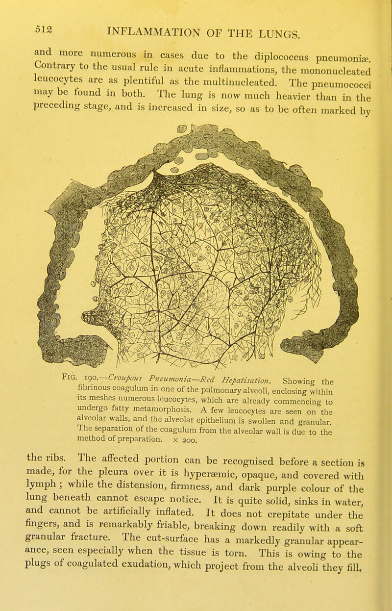 and more numerous in cases due to the diplococcus pneumonia. Contrary to the usual rule in acute inflammations, the mononucleated leucocytes are as plentiful as the multinucleated. The pneumococci may be found in both. The lung is now much heavier than in the preceding stage, and is increased in size, so as to be often marked by Fig. -L^o.—Croupous Pneumonia—Red Hepatisation. Showing the fibrinous coagulum in one of the pulmonary alveoli, enclosing within Its meshes numerous leucocytes, which are already commencing to undergo fatty metamorphosis. A few leucocytes are seen on the alveolar walls, and the alveolar epithelium is swollen and granular. The separation of the coagulum from the alveolar wall is due to the method of preparation, x 200. the ribs. The affected portion can be recognised before a section is made, for the pleura over it is hypersemic, opaque, and covered with lymph ; while the distension, firmness, and dark purple colour of the lung beneath cannot escape notice. It is quite solid, sinks in water, and cannot be artificially inflated. It does not crepitate under the fingers, and is remarkably friable, breaking down readily with a soft granular fracture. The cut-surface has a markedly granular appear- ance, seen especially when the tissue is torn. This is owing to the plugs of coagulated exudation, which project from the alveoli they fill.