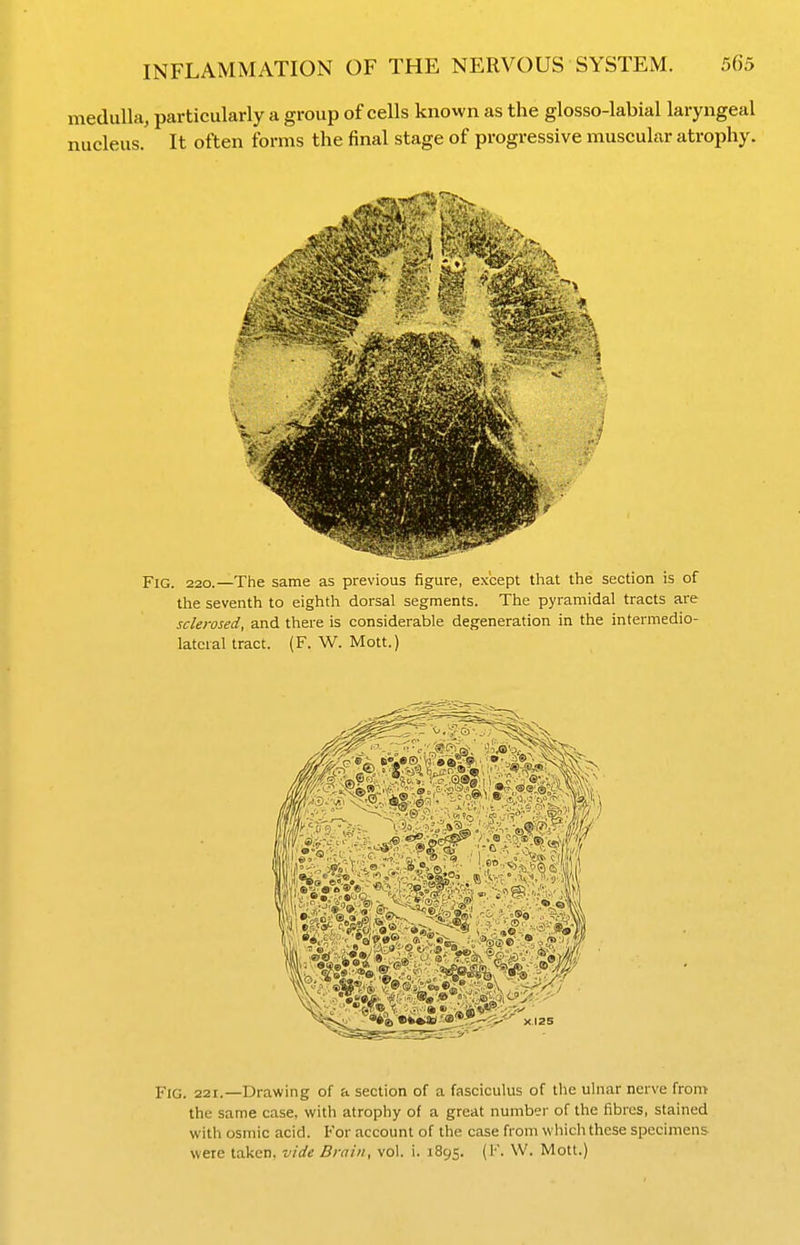 medulla, particularly a group of cells known as the glosso-labial laryngeal nucleus. It often forms the final stage of progressive muscular atrophy. Fig. 220.—The same as previous figure, except that the section is of the seventh to eighth dorsal segments. The pyramidal tracts are sclerosed, and there is considerable degeneration in the intermedio- latcral tract. (F. W. Mott.) Fig. 221.—Drawing of a section of a fasciculus of the ulnar nerve from the same case, with atrophy of a great number of the fibres, stained with osmic acid. For account of the case from which these specimens were taken, vide Drain, vol. i. 1895. (I'. W. Mott.)