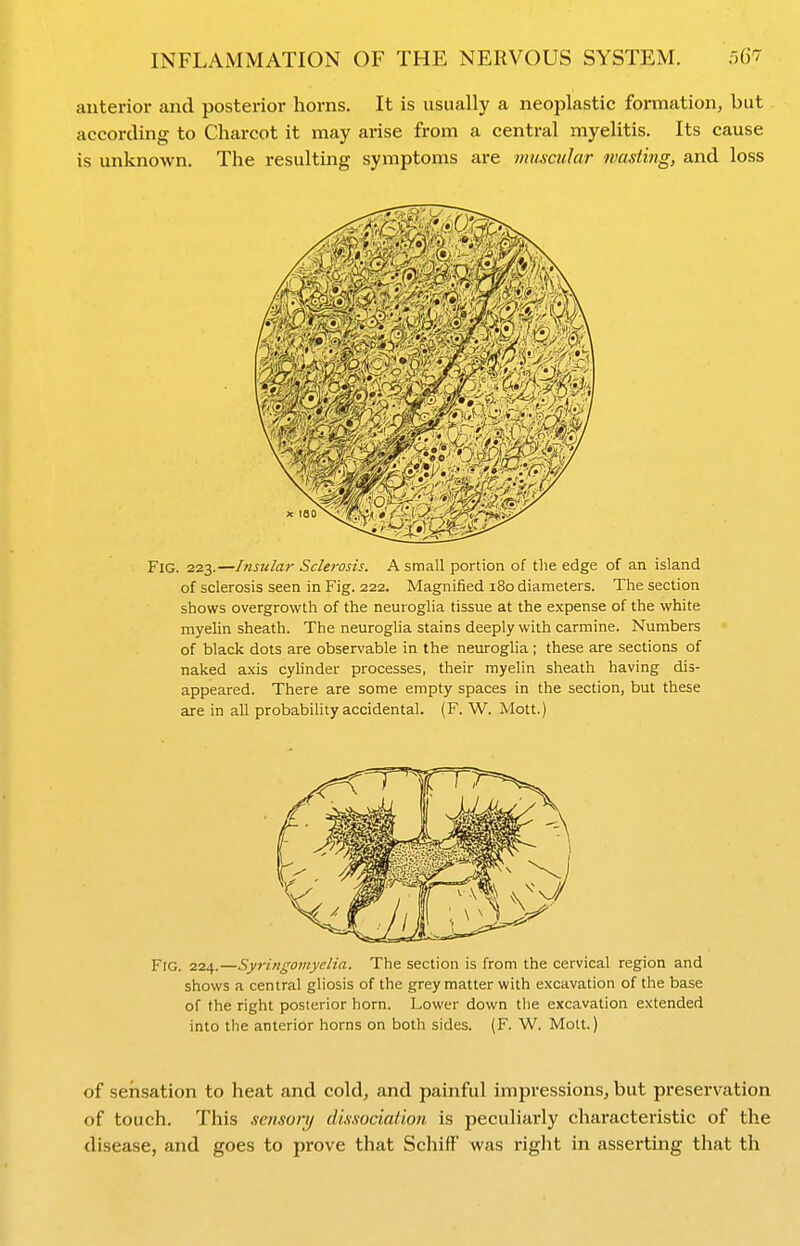 anterior and posterior horns. It is usually a neoplastic formation, but according to Charcot it may arise from a central myelitis. Its cause is unknown. The resulting symptoms are muscular wasting, and loss Fig. 223.—Insular Sclerosis. A small portion of the edge of an island of sclerosis seen in Fig. 222. Magnified 180 diameters. The section shows overgrowth of the neuroglia tissue at the expense of the white myelin sheath. The neuroglia stains deeply with carmine. Numbers of black dots are observable in the neuroglia ; these are sections of naked axis cyhnder processes, their myelin sheath having dis- appeared. There are some empty spaces in the section, but these are in all probability accidental. (F. W. Mott.) Fig. 224.—Syringomyelia. The section is from the cervical region and shows a central gliosis of the grey matter with excavation of the base of the right posterior horn. Lower down the excavation extended into the anterior horns on both sides. (F. W. Molt.) of sensation to heat and cold, and painful impressions, but preservation of touch. This seiisoi'y dissociation is peculiarly characteristic of the disease, and goes to prove that Schift was right in asserting that th