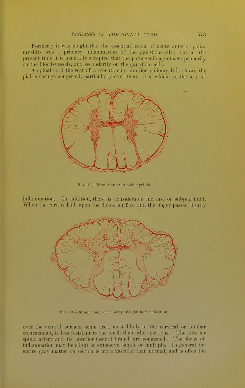 Formerly it was taught that tlie essential lesion of acute anterior polio- myelitis was a primary infianimation of the ganglion-cells; but at the present time it is generally accepted that the pathogenic agent acts primarily on the blood-vessels, and secondarily on the ganglion-cells. A spinal cord the seat of a recent acute anterior poliomyelitis shows the pial coverings congested, particularly over those areas which are the seat of Fig. 182.—Chronic anterior poliomyelitis. inflammation. In addition, there is considerable increase of subpial fluid. AVhen the coi'd is laid upon the dorsal surface and the finger passed lightly Fig. 18;!.—Chronic anterior polioniyolitis (aulhor'.s collection). over the ventral surface, some area, most likely in the cervical or lumbar enlargement, is less resistant to the touch than other portions. The anterior s))iiial artery and its anterior flssural branch arc congested. The focus of inflammation may be slight or extensive, single or multiple. In general tlic entire gray matter on section is more vascular than normal, and is often the