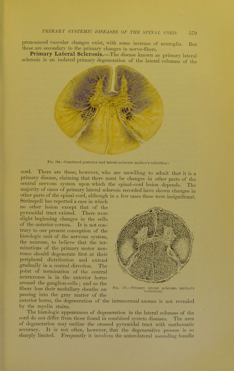 pronounced vasjculur changes exist, with some increase of neuroglia. Jkit these are secondaiy to tlie primary changes in nerve-fibers. Primary I^ateral Sclerosis.—The disease known as primary lateral sclerosis is an isolated primai-y degeneration of tlie lateral column's of the Fig. 184—Combined posterior and lateral sclerosis (author's collection). cord. There are those, however, who are unwilling to admit that it is a primary disease, claiming that there must be changes in other parts of the central nervous system upon which the spinal-cord lesion depends. The majority of cases of primary lateral sclerosis recorded have shown changes in other parts of the spinal cord, although in a few cases these were insignificant. Striimpell has reported a case in which no other lesion except that of the pyramidal tract existed. There were slight beginning changes in the cells of the anterior cornua. It is not con- trary to our present conception of the histologic unit of the nervous system, the neurone, to believe that the ter- minations of the primary motor neu- rones should degenerate first at their peripheral distribution and extend gradually in a central direction. The point of termination of the central neuraxones is in the anterior horns around the ganglion-cells ; and as the fibers lo.se their medullary sheaths on passing into the gray matter of the anterior horns, the degeneration of the intracornual axones is not revealed by the myelin stains. The histologic appearances of degeneration in the lateral columns of the cord do not differ from tliose found in combined system diseases. The area of degeneration may outline the crossed ]iyrami(lal tract with matheniatic accuracy. It is not often, however, that the degenerative process is so sharply limited. Frequently it involves the anterolateral ascending bimdle FlO. LVv Primary Intoral sclerosis (author's oolk'ction).