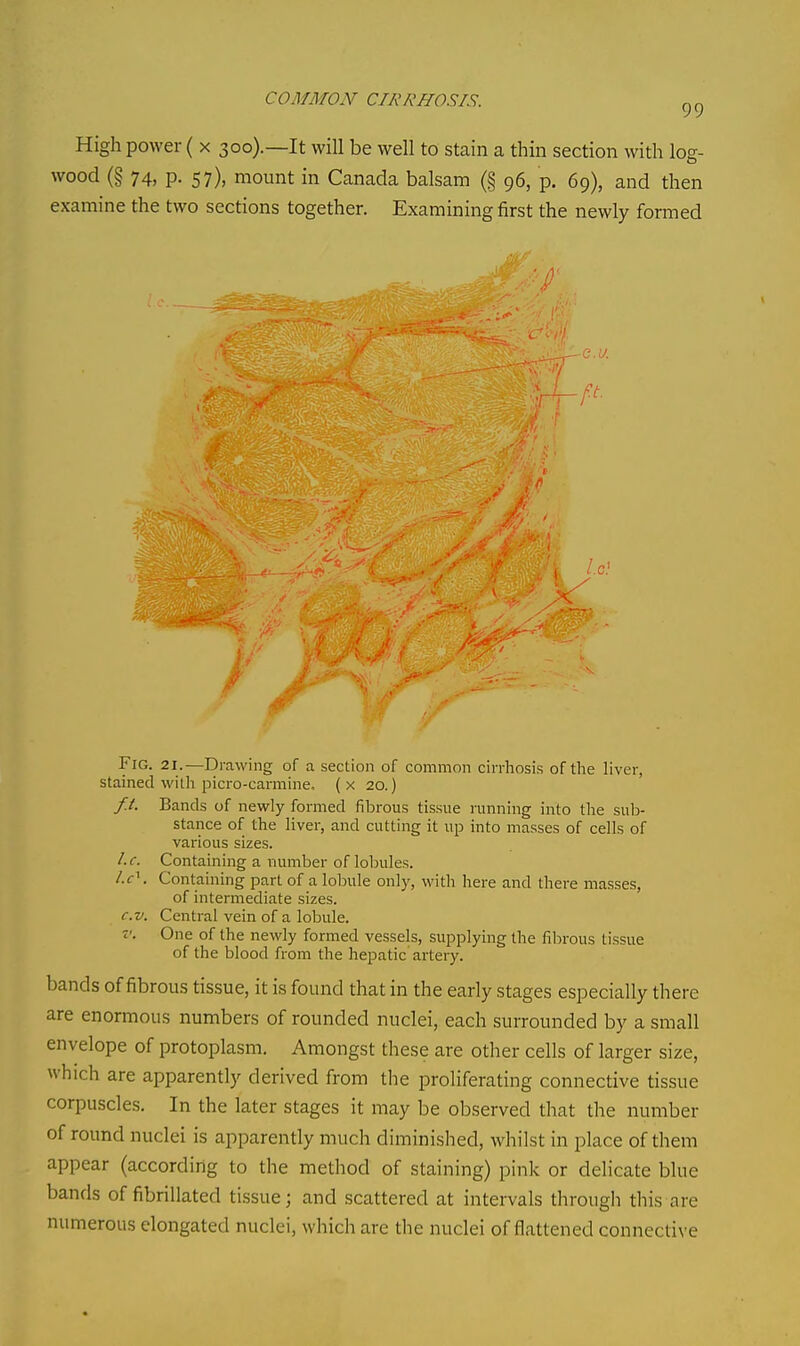 High power ( x 300).—It will be well to stain a thin section with log- wood (§ 74, p. 57), mount in Canada balsam (§ 96, p. 69), and then examine the two sections together. Examining first the newly formed Fig. 21.—Drawing of a section of common cirrhosis of the liver, stained with picro-carmine. (x 20.) f.t. Bands of newly formed fibrous tissue running into the sul> stance of the liver, and cutting it up into masses of cells of various sizes. I.e. Containing a number of lobules. /.<:\ Containing part of a lobule only, with here and there masses, of intermediate sizes. c.v. Central vein of a lobule. V. One of the newly formed vessels, supplying the fibrous tissue of the blood from the hepatic artery. bands of fibrous tissue, it is found that in the early stages especially there are enormous numbers of rounded nuclei, each surrounded by a small envelope of protoplasm. Amongst these are other cells of larger size, which are apparently derived from the proliferating connective tissue corpuscles. In the later stages it may be observed that the number of round nuclei is apparently much diminished, whilst in place of them appear (according to the method of staining) pink or delicate blue bands of fibrillated tissue; and scattered at intervals through this are numerous elongated nuclei, which are the nuclei of flattened connective