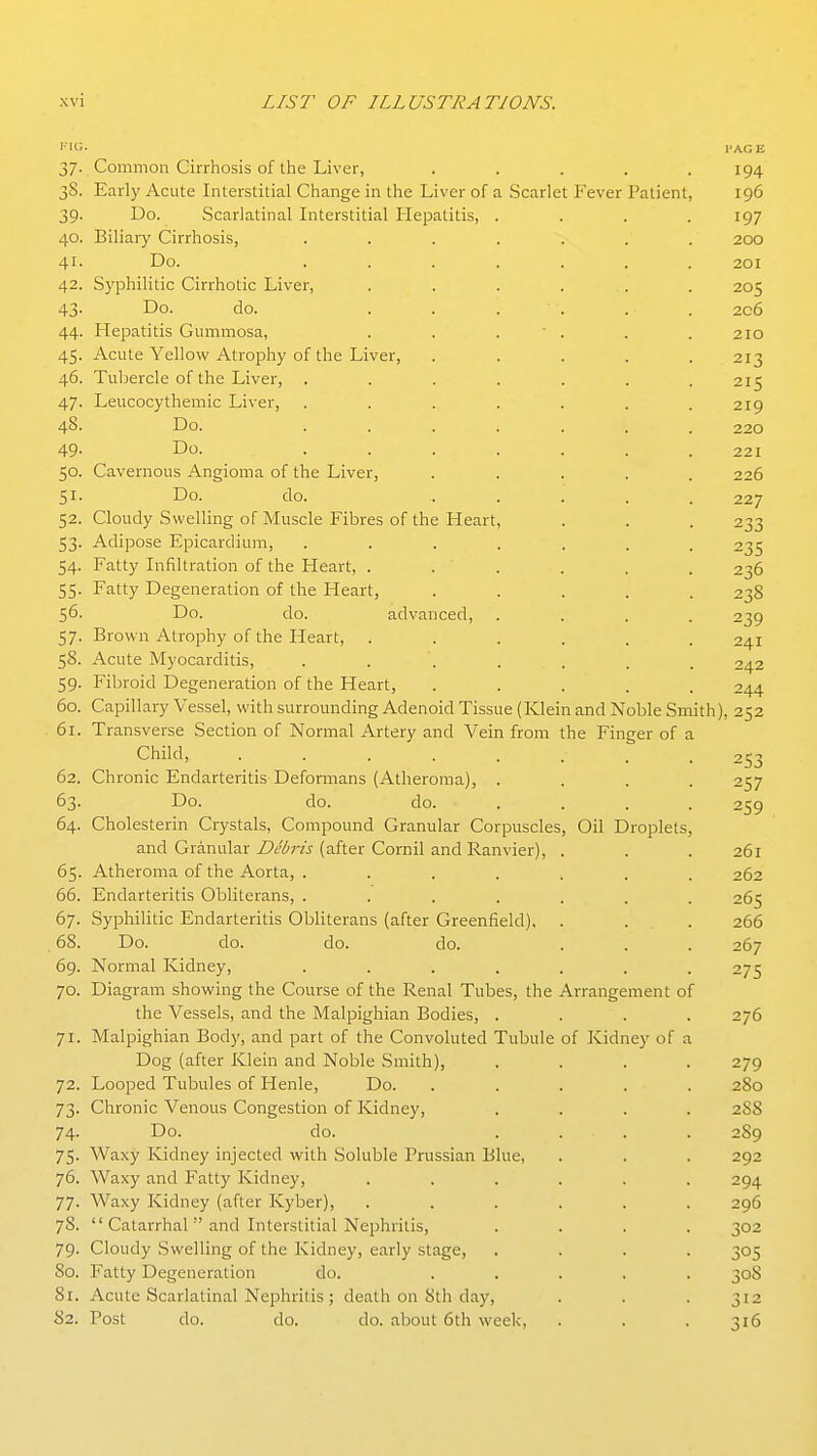 IMG. 37. Common Cirrhosis of the Liver, ..... 38. Early Acute Interstitial Change in the Liver of a Scarlet Fever Patient, 39- I5o. Scarlatinal Interstitial Hepatitis, .... 40. Biliary Cirrhosis, ....... 41. Do. ....... 42. Syphilitic Cirrhotic Liver, . . . . . 43. Do. do. ...... 44. Hepatitis Gummosa, . . . ■ . 45. Acute Yellow Atrophy of the Liver, ..... 46. Tubercle of the Liver, ....... 47. Leucocythemic Liver, ....... 48. Do. ....... 49- Do. ....... 50. Cavernous Angioma of the Liver, ..... 51. Do. do. . . . . . 52. Cloudy Swelling of Muscle Fibres of the Heart, 53. Adipose Epicardium, ....... 54. Fatty Infiltration of the Heart, ...... 55. Fatty Degeneration of the Heart, ..... 56. Do. do. advanced, .... 57. Brown Atrophy of the Heart, ...... 58. Acute Myocarditis, ....... 59. Fibroid Degeneration of the Heart, ..... 60. Capillary Vessel, with surrounding Adenoid Tissue (Klein and Noble Smi 61. Transverse Section of Normal Artery and Vein from the Finger of a Child, ........ 62. Chronic Endarteritis Deformans (Atheroma), . . . . 63. Do. do. do. .... 64. Cholesterin Crystals, Compound Granular Corpuscles, Oil Droplets, and Granular Z'd'iirw (after Cornil and Ranvier), . 65. Atheroma of the Aorta, ....... 66. Endarteritis Obliterans, ....... 67. Syphilitic Endarteritis Obliterans (after Greenfield), . ... 68. Do. do. do. do, 69. Normal Kidney, ....... 70. Diagram showing the Course of the Renal Tubes, the Arrangement of the Vessels, and the Malpighian Bodies, .... 71. Malpighian Body, and part of the Convoluted Tubule of Kidney of a Dog (after Klein and Noble Smith), .... 72. Looped Tubules of Henle, Do. ..... 73. Chronic Venous Congestion of Kidney, .... 74. Do. do. .... 75. Waxy Kidney injected with Soluble Prussian Blue, 76. Waxy and Fatty Kidney, ...... 77. Waxy Kidney (after Kyber), ...... 78.  Catarrhal and Interstitial Nephritis, . . . . 79. Cloudy Swelling of the Kidney, early stage, .... 80. Fatty Degeneration do. ..... 81. Acute Scarlatinal Nephritis ; death on Sth day, 82. Post do. do. do. about 6th week,