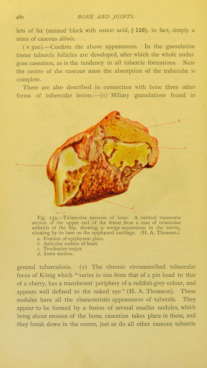lets of fat (stained black with osmic acid, § 110), in fact, simply a mass of caseous debris. ( X 300).—Confirm the above appearances. In the granulation tissue tubercle follicles are developed, after which the whole under- goes caseation, as is the tendency in all tubercle formations. Near the centre of the caseous mass the absorption of the trabeculse is complete. There are also described in connection with bone three other forms of tubercular lesion:—(i) Miliary granulations found in Fig. 133.—Tubercular necrosis of bone. A vertical transverse section of the upper end of the femur from a case of tubercular arthritis of the hip, showing a wedge-sequestrum in the cervix, abutting by its base on the epiphyseal cartilage. (H. A. Thomson.) a. Position of epiphyseal plate. b. Articular surface of head. c. Trochanter major. d. Sawn section. general tuberculosis. (2) The chronic circumscribed tubercular focus of Konig which  varies in size from that of a pin head to that of a cherry, has a translucent periphery of a reddish-grey colour, and appears well defined to the naked eye  (H. A. Thomson). These nodules have all the characteristic appearances of tubercle. They appear to be formed by a fusion of several smaller nodules, which bring about erosion of the bone, caseation takes place in them, and they break down in the centre, just as do all other caseous tubercle .41.
