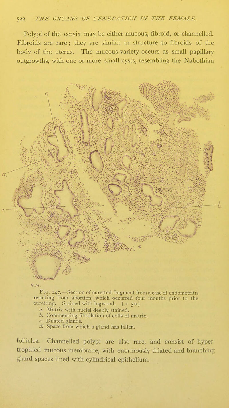 Polypi of the cervix may be either mucous, fibroid, or channelled. Fibroids are rare; they are similar in structure to fibroids of the body of the uterus. The mucous variety occurs as small papillary outgrowths, with one or more small cysts, resembling the Nabothian Fig. 147.—Section of curetted fragment from a case of endometritis resulting from abortion, which occurred four months prior to the curetting. Stained with logwood. ( x 50.) a. Matrix with nuclei deeply stained. b. Commencing fibrillation of cells of matrix. c. Dilated glands. d. Space from which a gland has fallen. follicles. Channelled polypi are also rare, and consist of hyper- trophied mucous membrane, with enormously dilated and branching gland spaces lined with cylindrical epithelium.