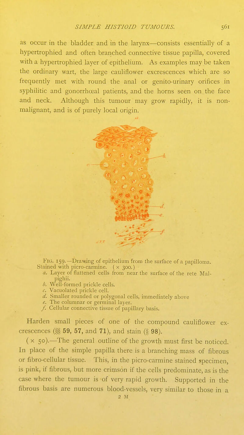as occur in the bladder and in the larynx—consists essentially of a hypertrophied and often branched connective tissue papilla, covered with a hypertrophied layer of epithelium. As examples may be taken the ordinary wart, the large cauliflower excrescences which are so frequently met with round the anal or genito-urinary orifices in syphilitic and gonorrhoeal patients, and the horns seen on the face and neck. Although this tumour may grow rapidly, it is non- malignant, and is of purely local origin. Fig. 159.—Drawing of epithelium from the surface of a papilloma. Stained with picro-carmine. ( x 300.) a. Layer of flattened cells from near the surface of the rete Mal- pighii. b. Well-formed prickle cells. c. Vacuolated prickle cell. d. .Smaller rounded or polygonal cells, immediately above e. The columnar or germinal layer. /. Cellular connective tissue of papillary basis. Harden small pieces of one of the compound cauliflower ex- crescences (§§ 59, 57, and 71), and stain (§ 98). ( X 50).—The general outline of the growth must first be noticed. In place of the simple papilla there is a branching mass of fibrous or fibro-cellular tissue. This, in the picro-cannine stained specimen, is pink, if fibrous, but more crimson if the cells predominate, as is the case where the tumour is of very rapid growth. Supported in the fibrous basis are numerous blood-vessels, very similar to those in a 2 M