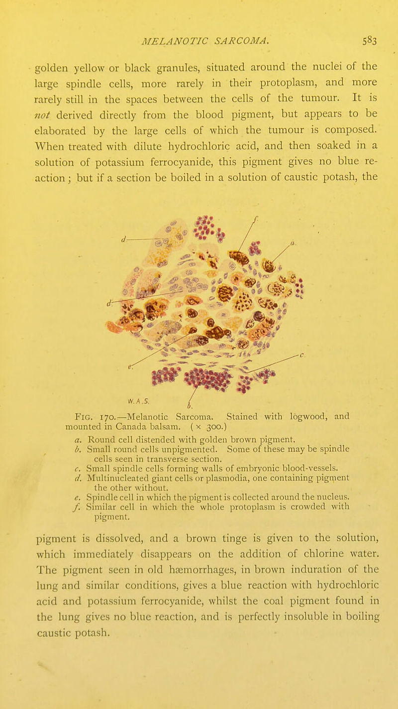 golden yellow or black granules, situated around the nuclei of the large spindle cells, more rarely in their protoplasm, and more rarely still in the spaces between the cells of the tumour. It is not derived directly from the blood pigment, but appears to be elaborated by the large cells of which the tumour is composed. When treated with dilute hydrochloric acid, and then soaked in a solution of potassium ferrocyanide, this pigment gives no blue re- action ; but if a section be boiled in a solution of caustic potash, the P'iG. 170.—Melanotic Sarcoma. Stained with logwood, and mounted in Canada balsam. ( x 300.) a. Round cell distended with golden brown pigment. b. Small round cells unpigmented. Some of these may be spindle cells seen in transverse section. c. Small spindle cells forming walls of embryonic blood-vessels. d. Multinucleated giant cells or plasmodia, one containing pigment the other without. e. Spindle cell in which the pigment is collected around the nucleus. /. Similar cell in which the whole protoplasm is crowded with pigment. pigment is dissolved, and a brown tinge is given to the solution, which immediately disappears on the addition of chlorine water. The pigment seen in old heemorrhages, in brown induration of the lung and similar conditions, gives a blue reaction with hydrochloric acid and potassium ferrocyanide, whilst the coal pigment found in the lung gives no blue reaction, and is perfectly insoluble in boiling caustic potash.