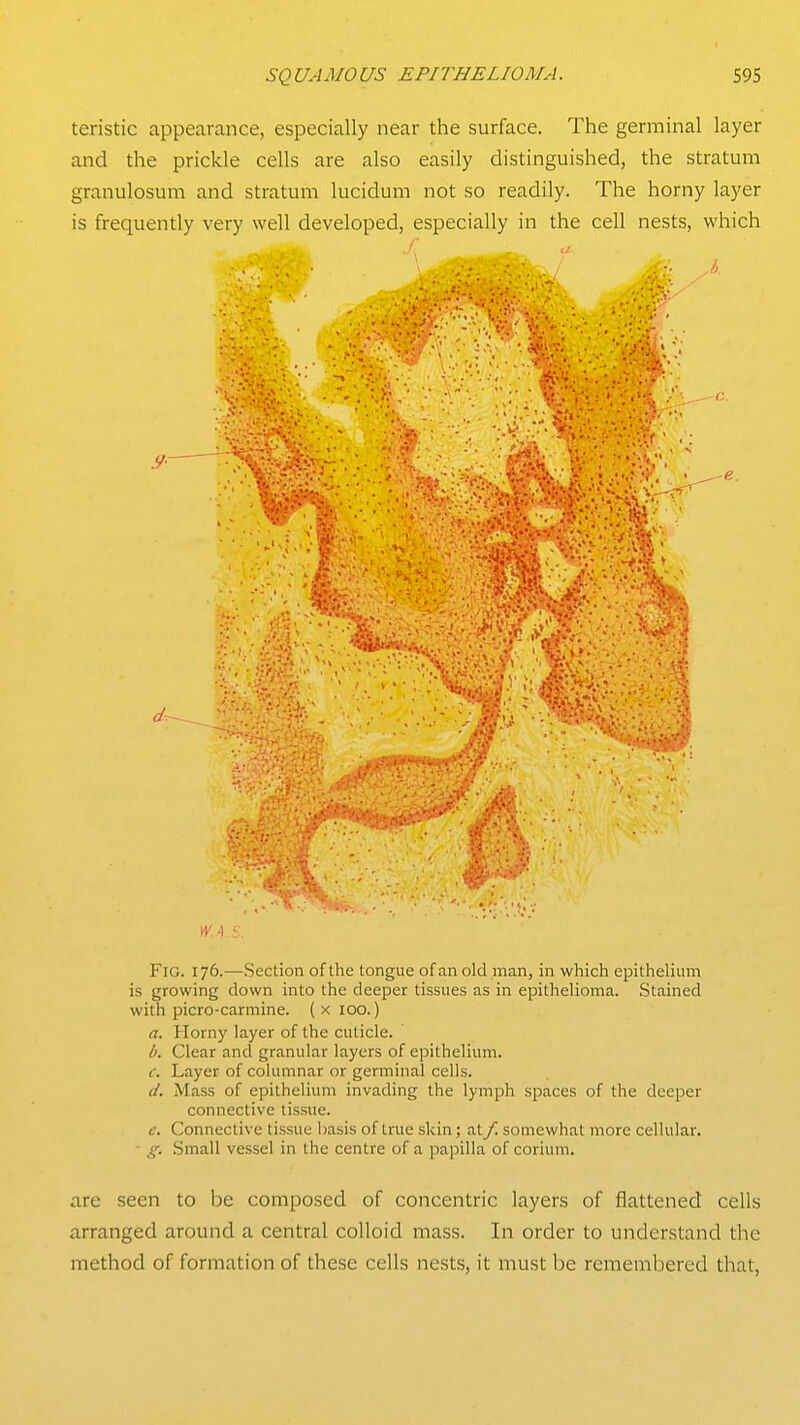 teristic appearance, especially near the surface. The germinal layer and the prickle cells are also easily distinguished, the stratum granulosum and stratum lucidum not so readily. The horny layer is frequently very well developed, especially in the cell nests, which Fig. 176.—Section of the tongue of an old man, in which epithelium is growing down into the deeper tissues as in epithelioma. Stained with picro-carmine. ( x 100.) a. Horny layer of the cuticle. b. Clear and granular layers of epithelium. c. Layer of columnar or germinal cells. d. Mass of epithelium invading the lymph spaces of the deeper connective tissue. c. Connective tissue basis of true skin; at f. somewhat more cellular. ■ g. .Small vessel in the centre of a papilla of corium. are seen to be composed of concentric layers of flattened cells arranged around a central colloid mass. In order to understand the method of formation of these cells nests, it must be remembered that,