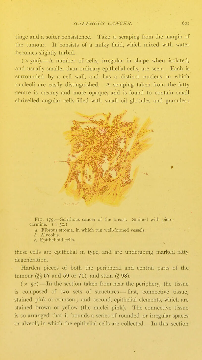 tinge and a softer consistence. Take a scraping from the margin of the tumour. It consists of a milky fluid, which mixed with water becomes slightly turbid. (X 300).—A number of cells, irregular in shape when isolated, and usually smaller than ordinary epithelial cells, are seen. Each is surrounded by a cell wall, and has a distinct nucleus in which nucleoli are easily distinguished. A scraping taken from the fatty centre is creamy and more opaque, and is found to contain small shrivelled angular cells filled with small oil globules and granules; Fig. 179.—Scirrhous cancer of the breast. Stained with picro- cartnine. ( x 50.) a. Fibrous stroma, in which run well-formed vessels. b. Alveolus. c. Epithelioid cells. these cells are epithelial in type, and are undergoing marked fatty ■degeneration. Harden pieces of both the peripheral and central parts of the tumour (§§ 57 and 59 or 71), and stain (§ 98). (X 50).—In the section taken from near the periphery, the tissue is composed of two sets of structures — first, connective tissue, stained pink or crimson; and second, epithelial elements, which are stained brown or yellow (the nuclei pink). The connective tissue is so arranged that it bounds a series of rounded or irregular spaces or alveoli, in which the epithelial cells are collected. In this section
