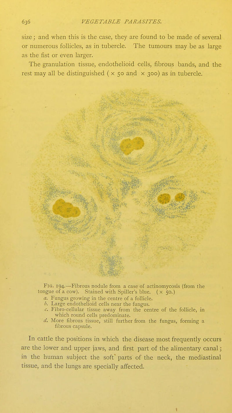 size; and when this is the case, they are found to be made of several or numerous folUcles, as in tubercle. The tumours may be as large as the fist or even larger. The granulation tissue, endothelioid cells, fibrous bands, and the rest may all be distinguished ( x 50 and x 300) as in tubercle. Fig. 194.—Fibrovis nodule from a case of actinomycosis (from the tongue of a cow). Stained with Spiller's blue, (x 50.) a. Fungus growing in the centre of a follicle. b. Large endothelioid cells near the fungus. c. Fibro-cellular tissue away from the centre of the follicle, in which round cells predominate. d. More fibrous tissue, still further from the fungus, forming a fibrous capsule. In cattle the positions in which the disease most frequently occurs are the lower and upper jaws, and first part of the alimentary canal; in the human subject the soft' parts of the neck, the mediastinal tissue, and the lungs are specially affected.