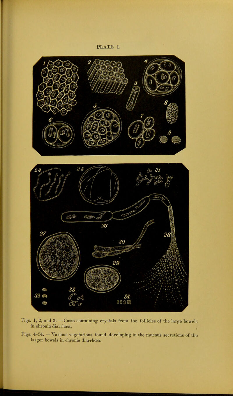Figs. 1, 2, and 3. — Casts contaiuing crystals from the follicles of the large bowels in chronic diarrhoea. , I'igs. 4-34. —Various vegetations found developing in the mucous secretions of the larger bowels in chronic diarrhoea.