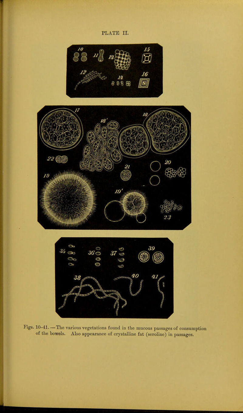 10-41. —The various vegetations found in the mucous passages of consumption of the bowels. Also appearance of crystalline fat (seroline) in passages.