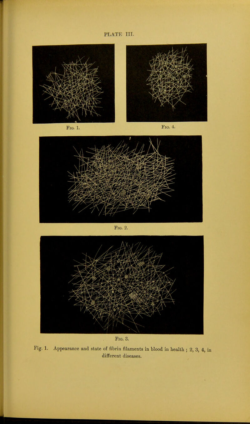 PLATE III. Fig. 3. Fig. 1. Appearance and state of fibrin filaments in blood in health ; 2, 3, 4, i different diseases.