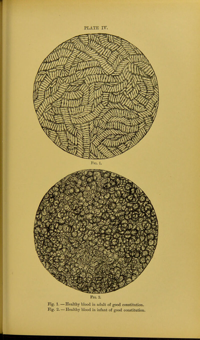 Fiot. 2. Kg. 1.—Healthy blood in adult of good constitution. Fig. 2. — Healthy blood in infant of good constitution.