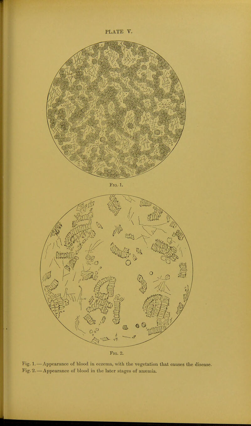 Fig. 2. Fig. 1. — Appearance of blood in eczema, with the vegetation that causes the disease. Fig. 2.—Appearance of blood in the later stages of anremia.